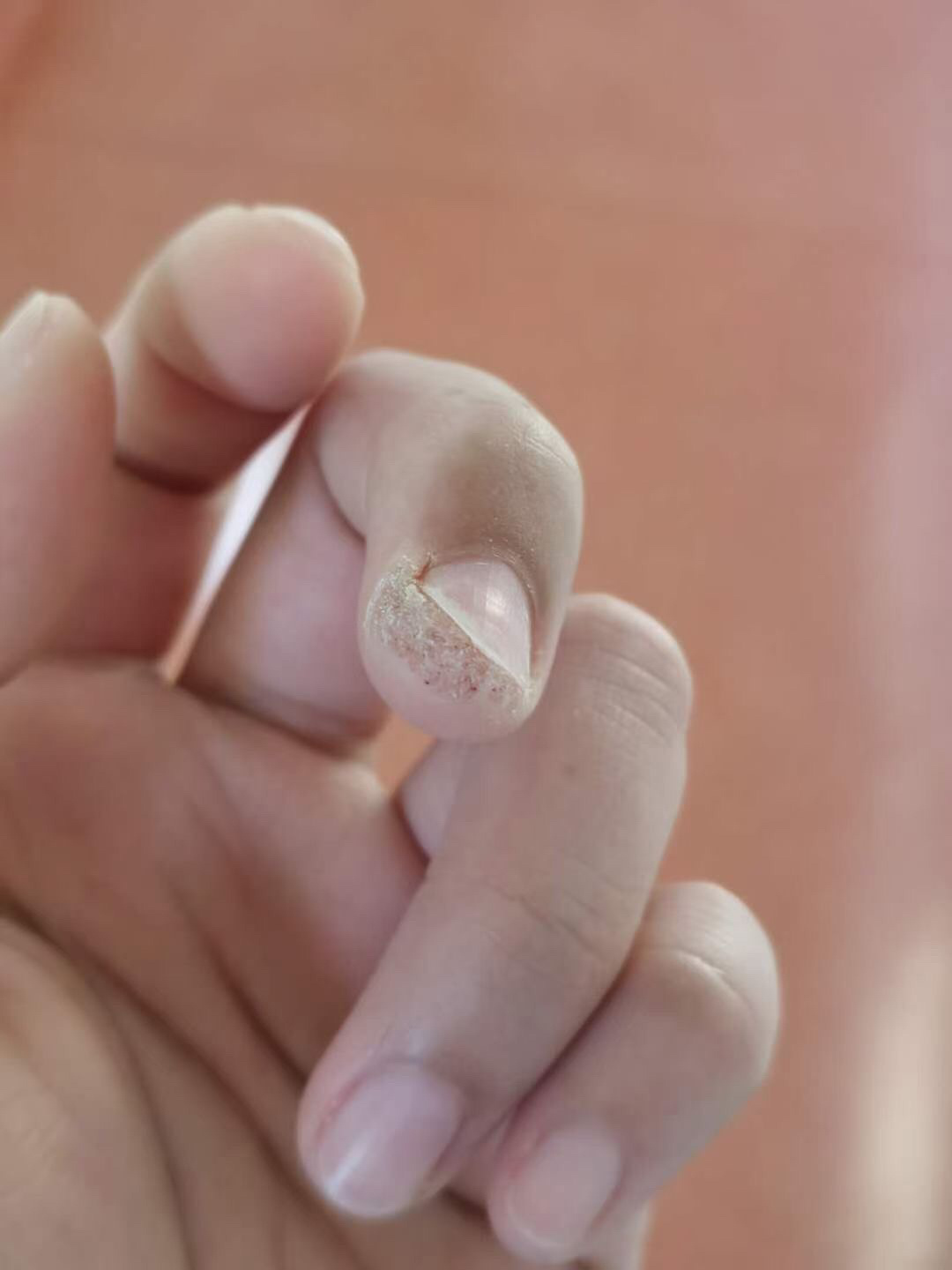 只是感染位置为甲周或甲下,称为甲周疣或甲下疣,可使指甲甲床破坏