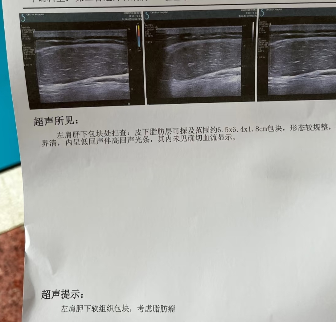 后背摸到硬疙瘩,最常见的是脂肪瘤或皮脂腺囊肿