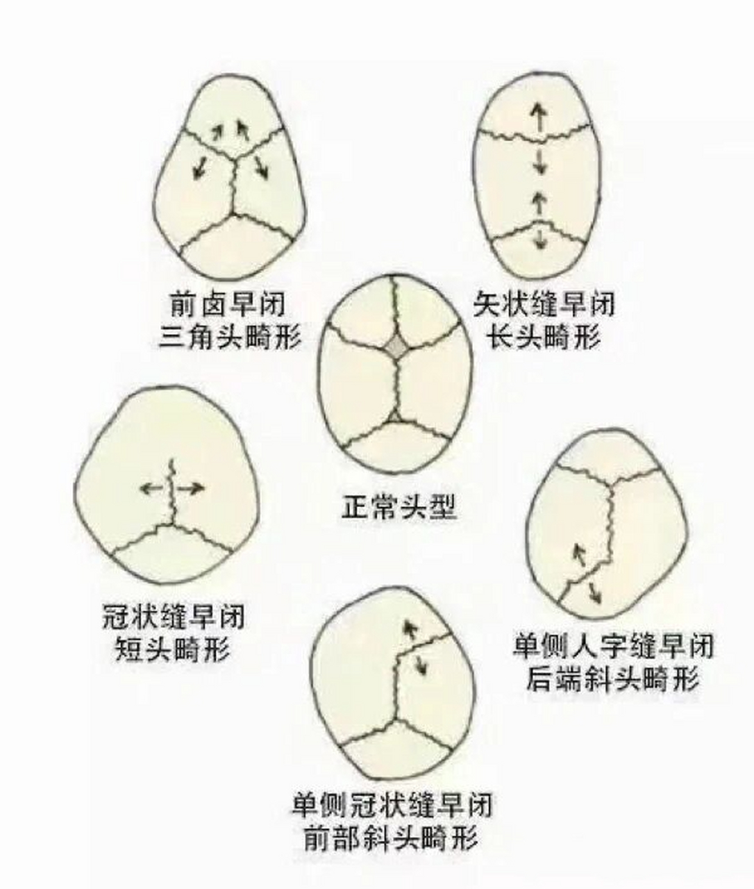 颅缝早闭的典型头型特点 临床表现为患儿出生时或出生后即出现某条颅