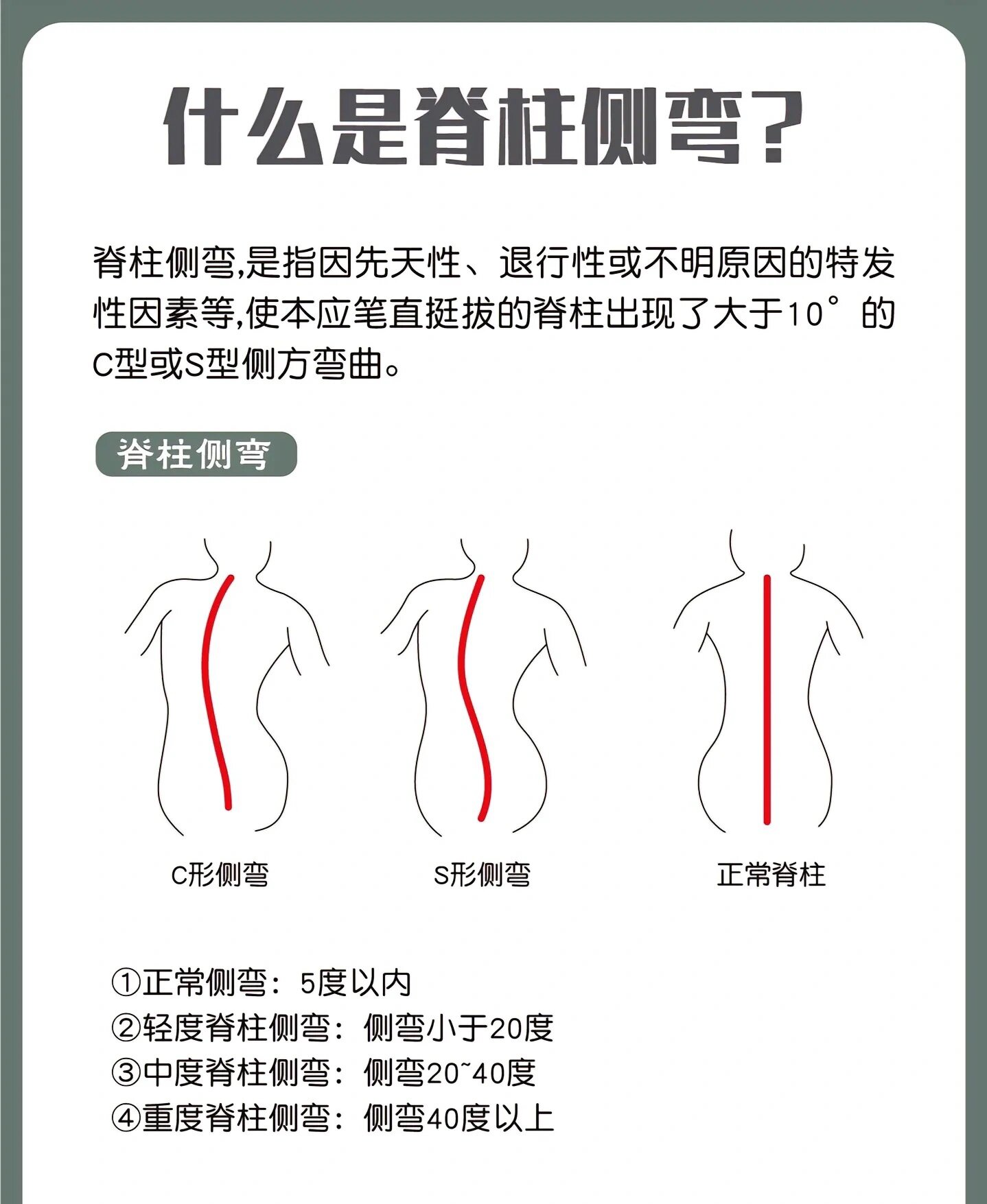 脊柱侧弯怎么看出来图片