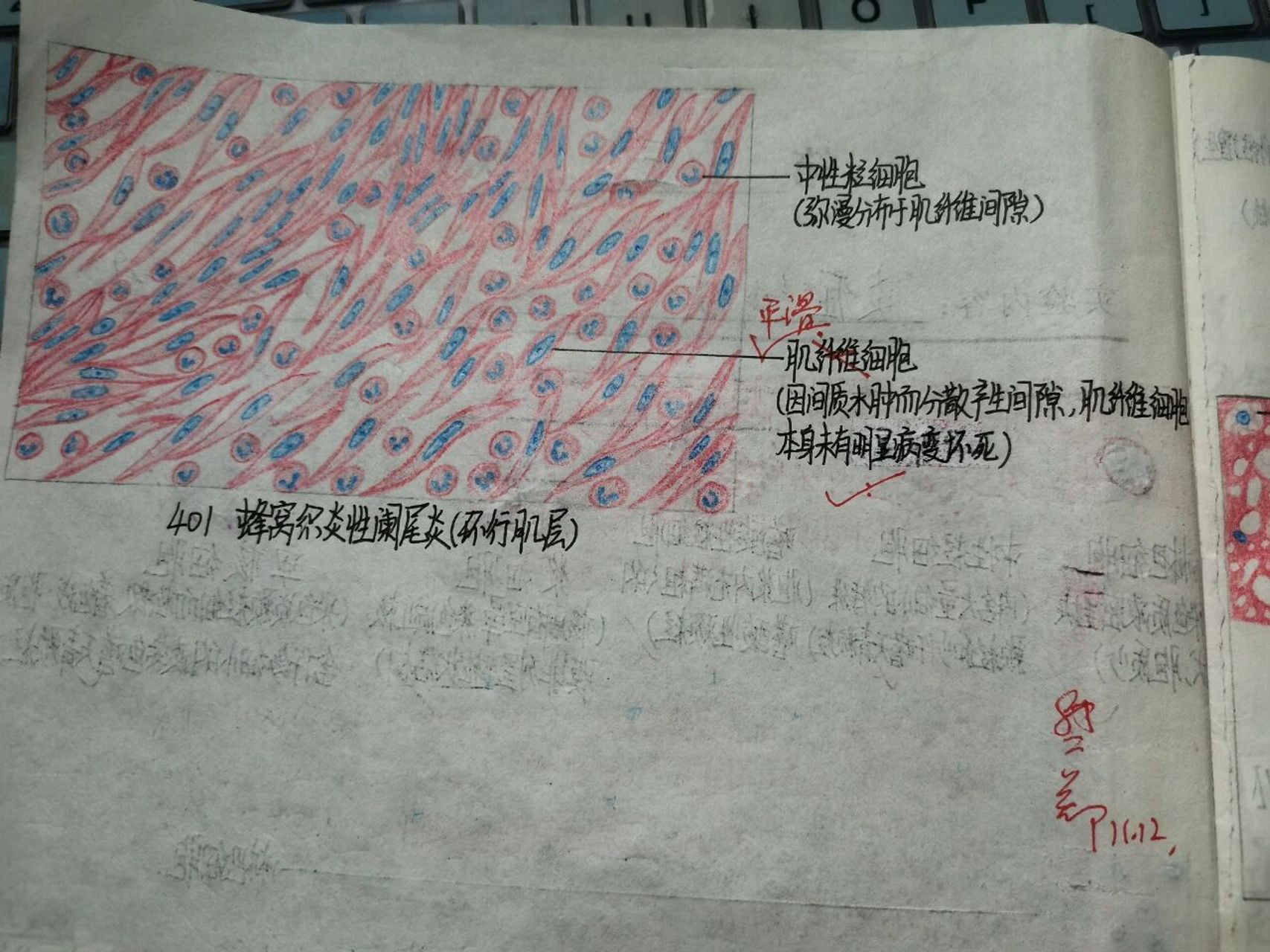 病理红蓝铅笔手绘图——炎症 99炎细胞 99淋巴结结核结节(肉芽肿