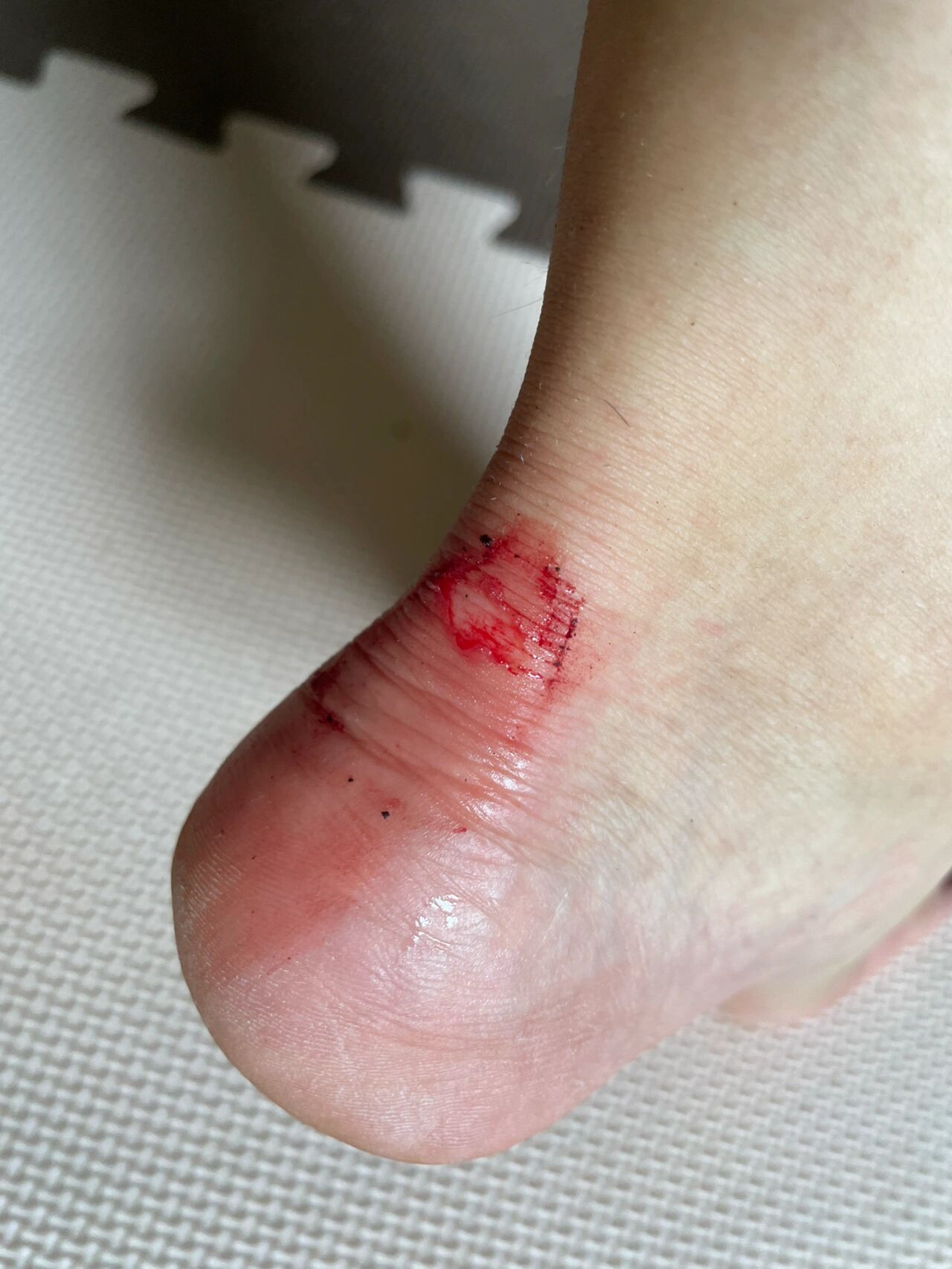 前几天偷了个懒,穿布鞋没穿袜子,脚后跟磨破皮,躺