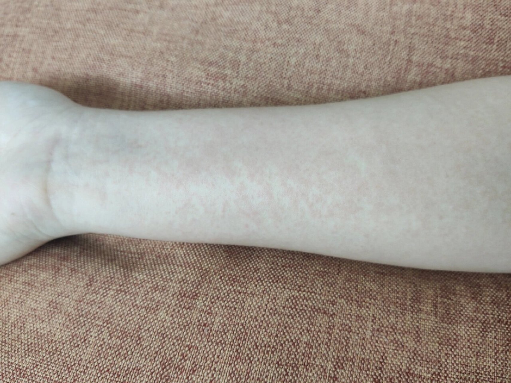 酒精过敏还起红疹  我酒量不好,好久不喝酒了,昨天在公司喝了点红酒