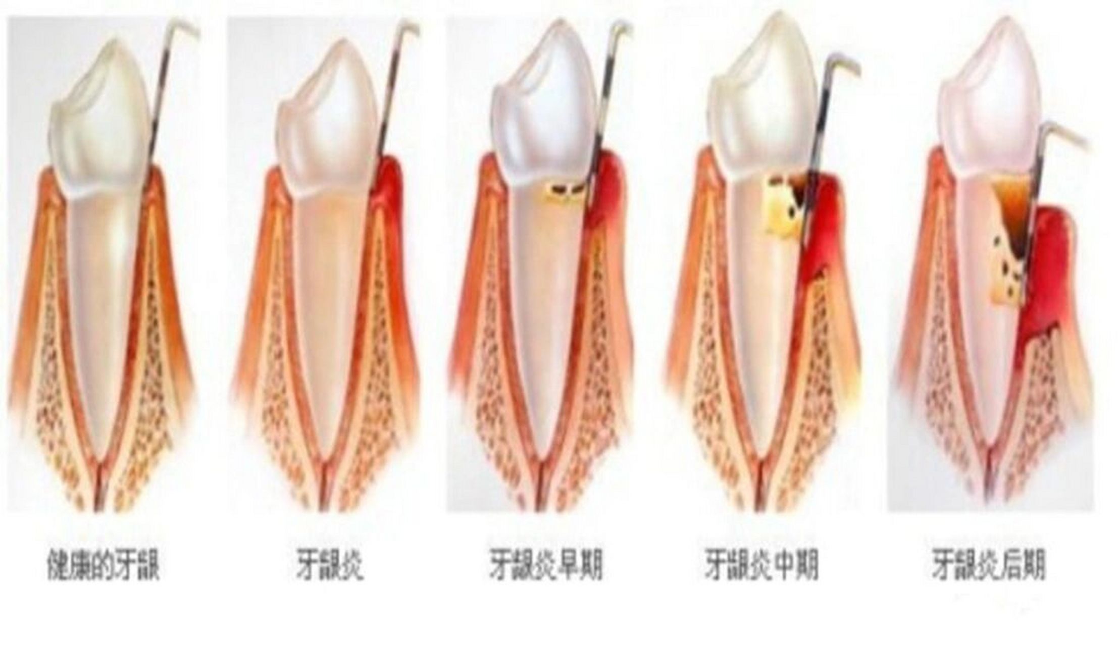 牙周病的自我检查方法 健康的牙周组织对牙齿的固位有着十分重要的