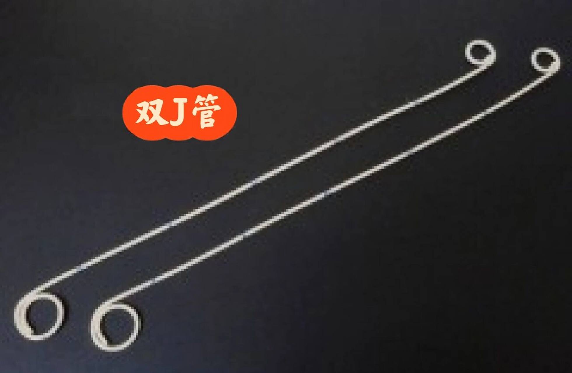 经皮肾镜手术后续-- 取出双j管 8215经皮肾镜手术的一个月后,要回