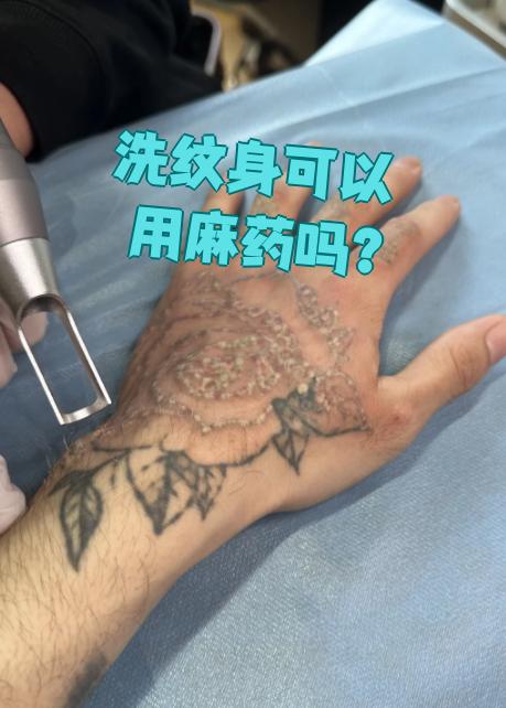 洗纹身可以用麻药,前提是你对麻药不过敏