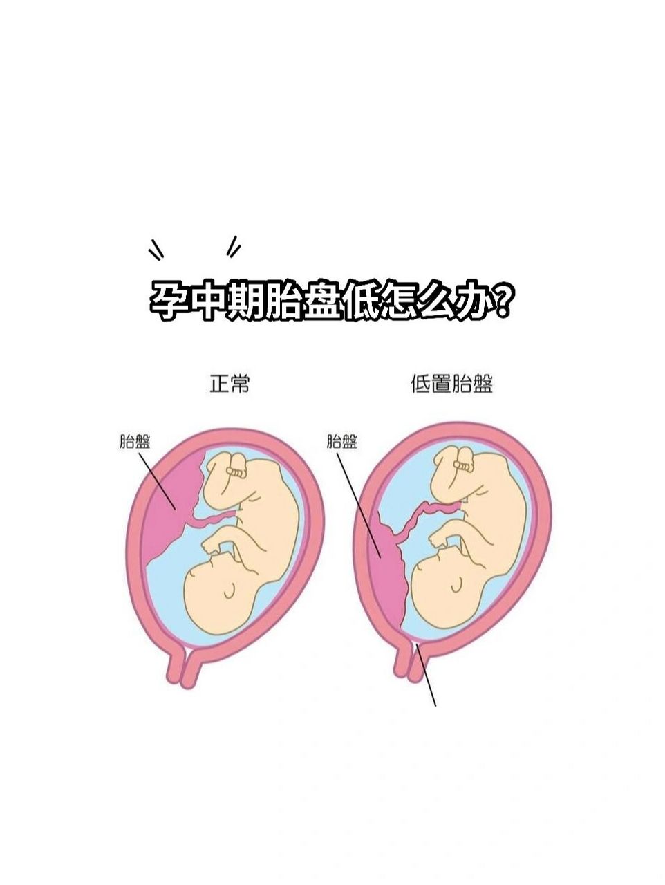 胎盘位置低图片