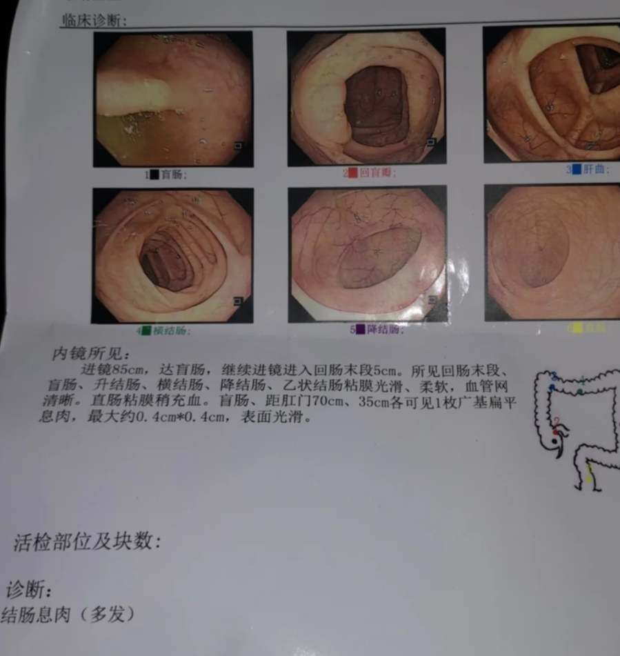 绒毛状腺瘤是大肠里常见的一种腺瘤性息肉
