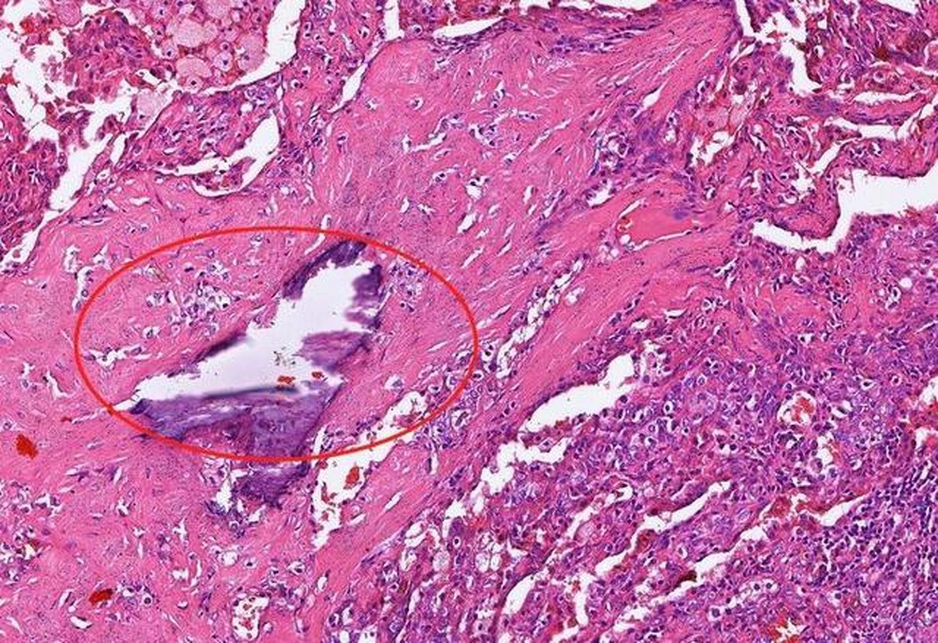 活检病理提示肺癌,手术切下来却是良性肿瘤,亏大了吗?
