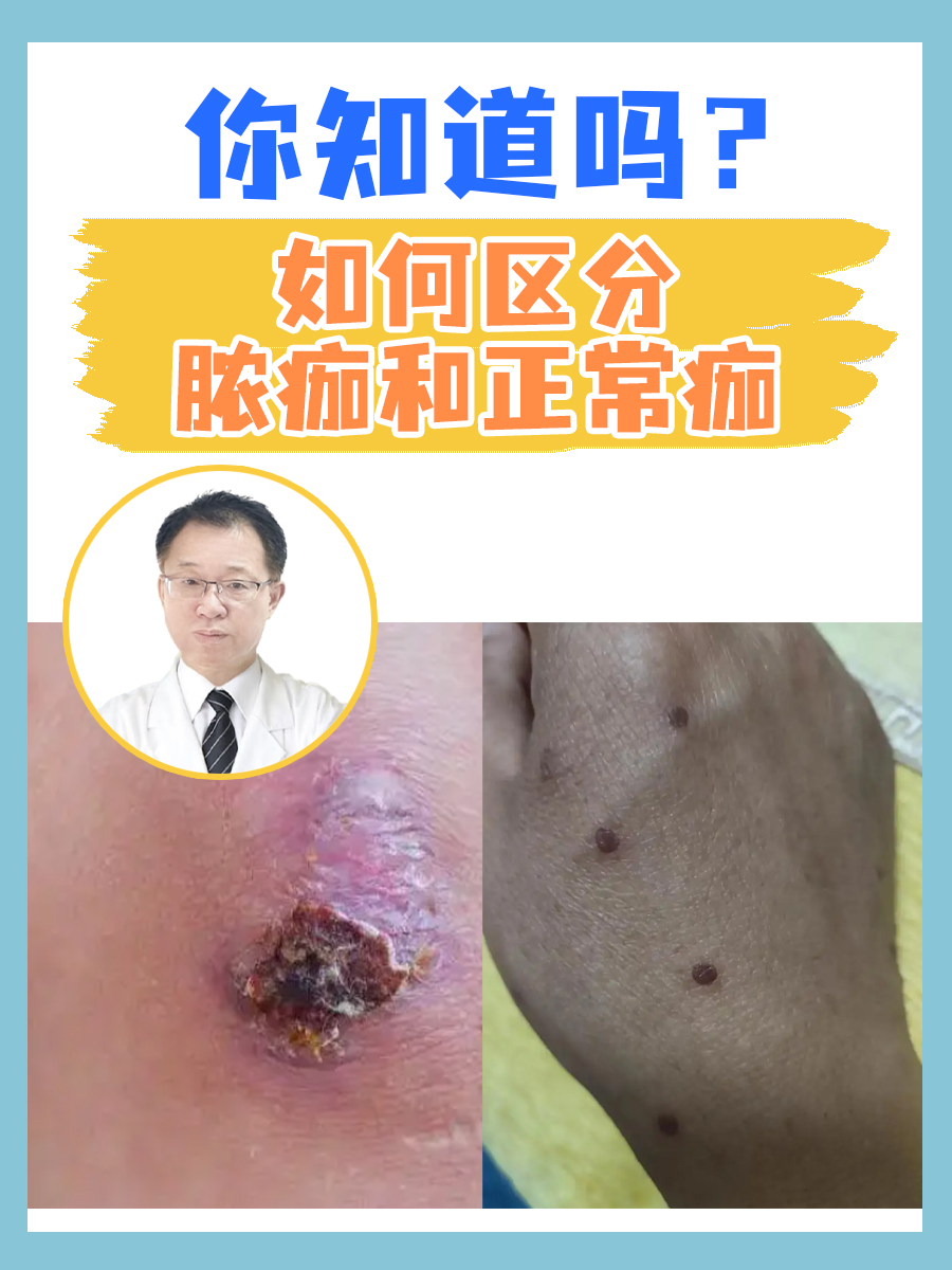 形成原因:正常痂是皮肤在受到轻微损伤后,为了保护伤口而形成的一层
