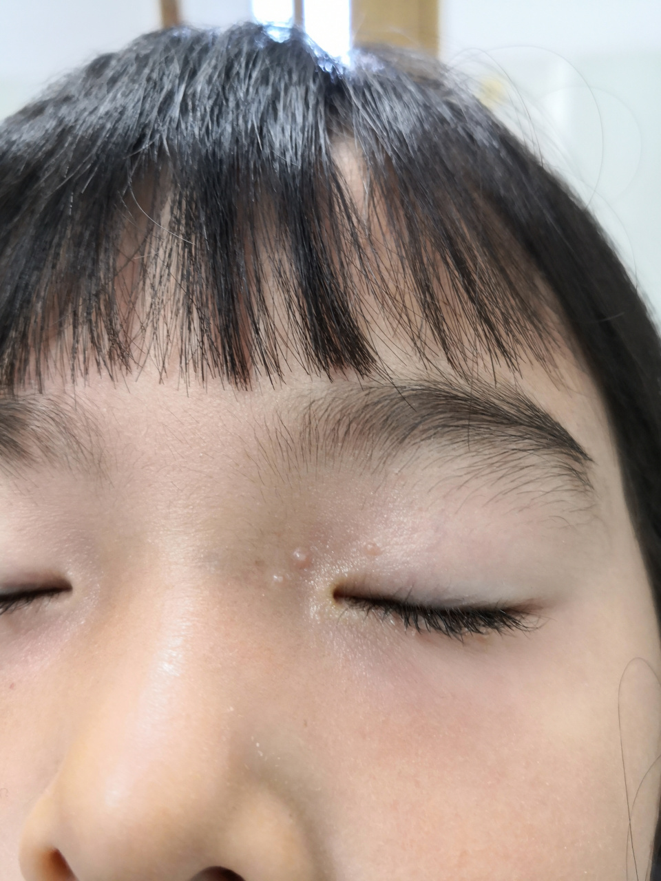 儿童传染性软疣症状.可以使用药物外用治疗或者挑治治疗.