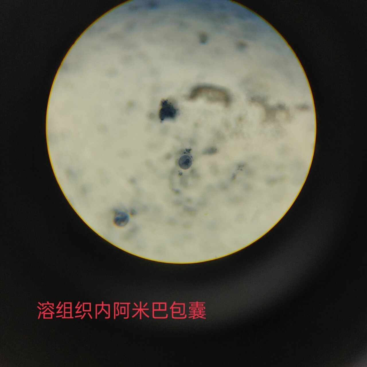 医学原虫镜下观察 ①溶组织内阿米巴包囊 (感染期为四核包囊,二分裂)