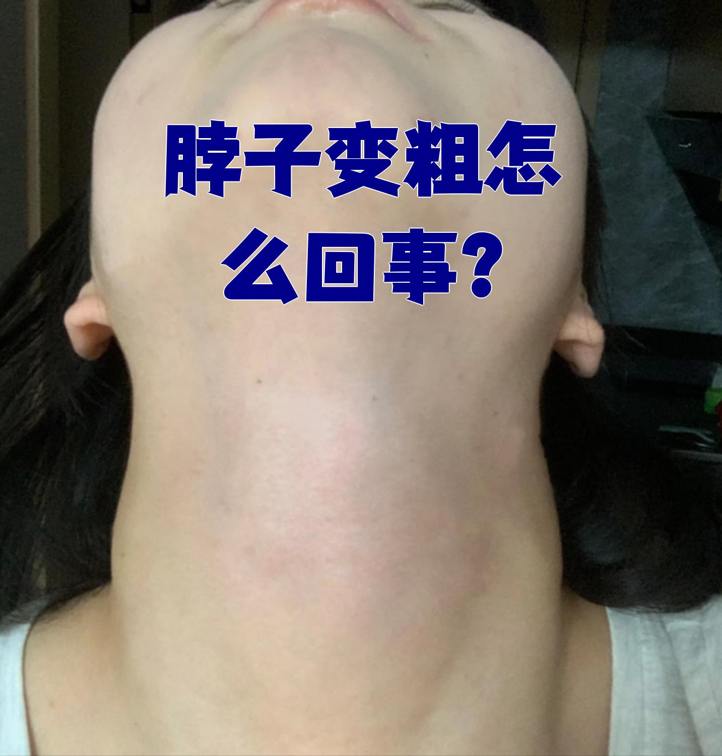 脖子变粗最常见的原因是甲状腺肿大或局部淋巴水肿