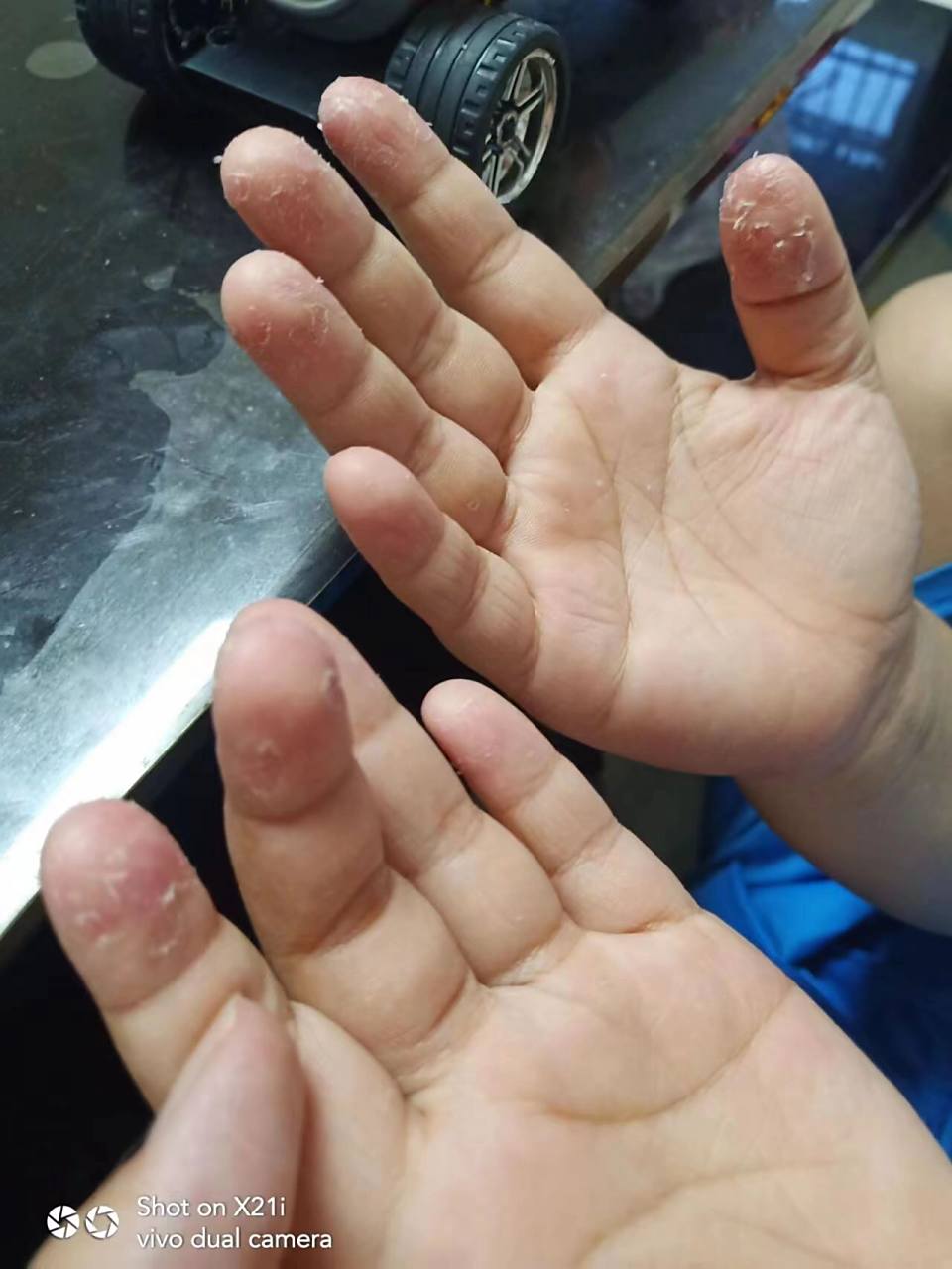 孩子手脱皮是怎么了?