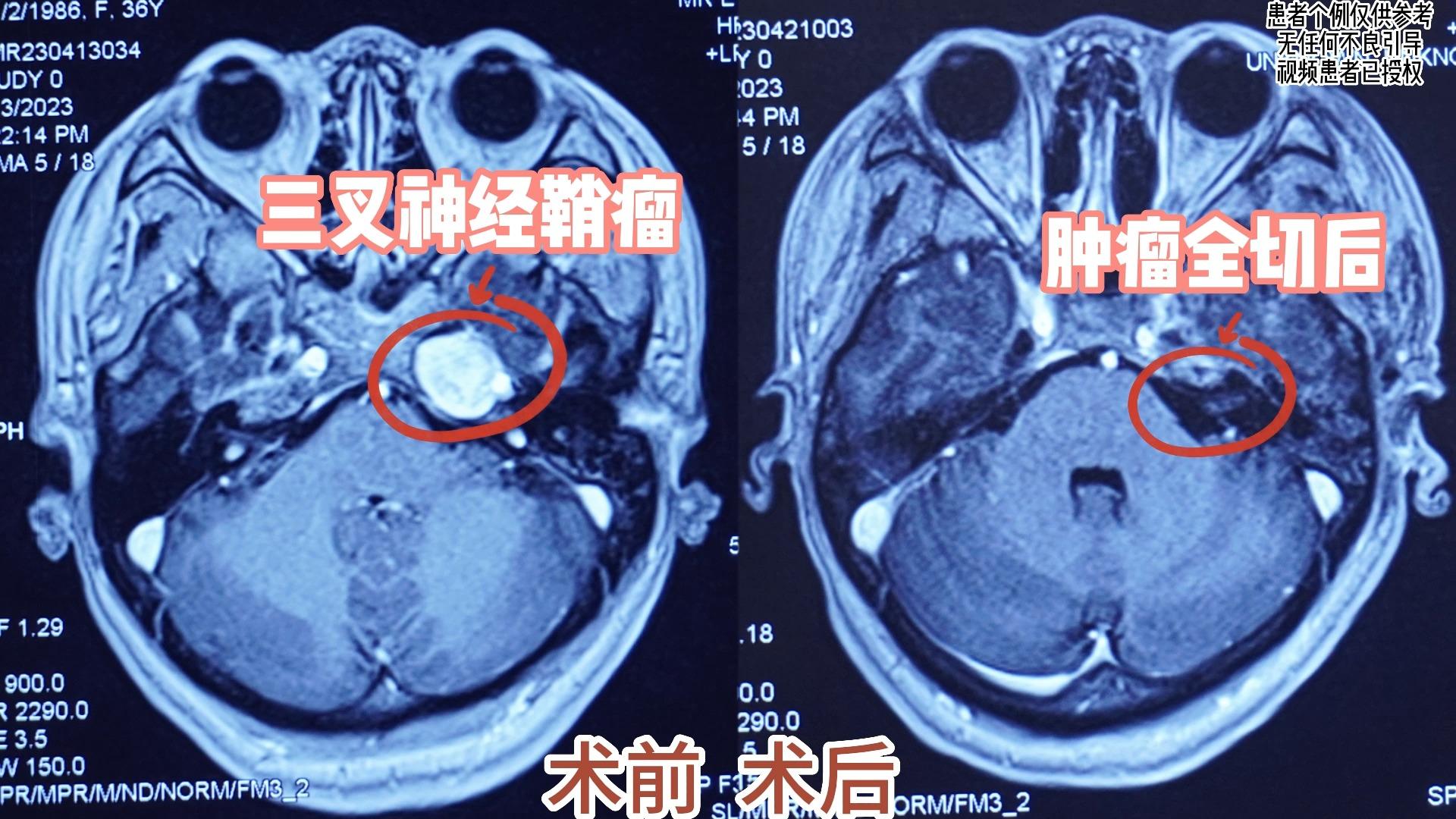 三叉神经瘤图片