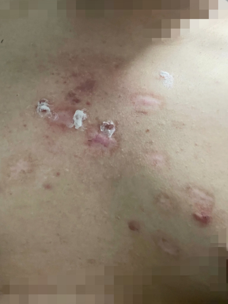 下图是同位素治疗导致的色脱,很多疤友有些接受不了.