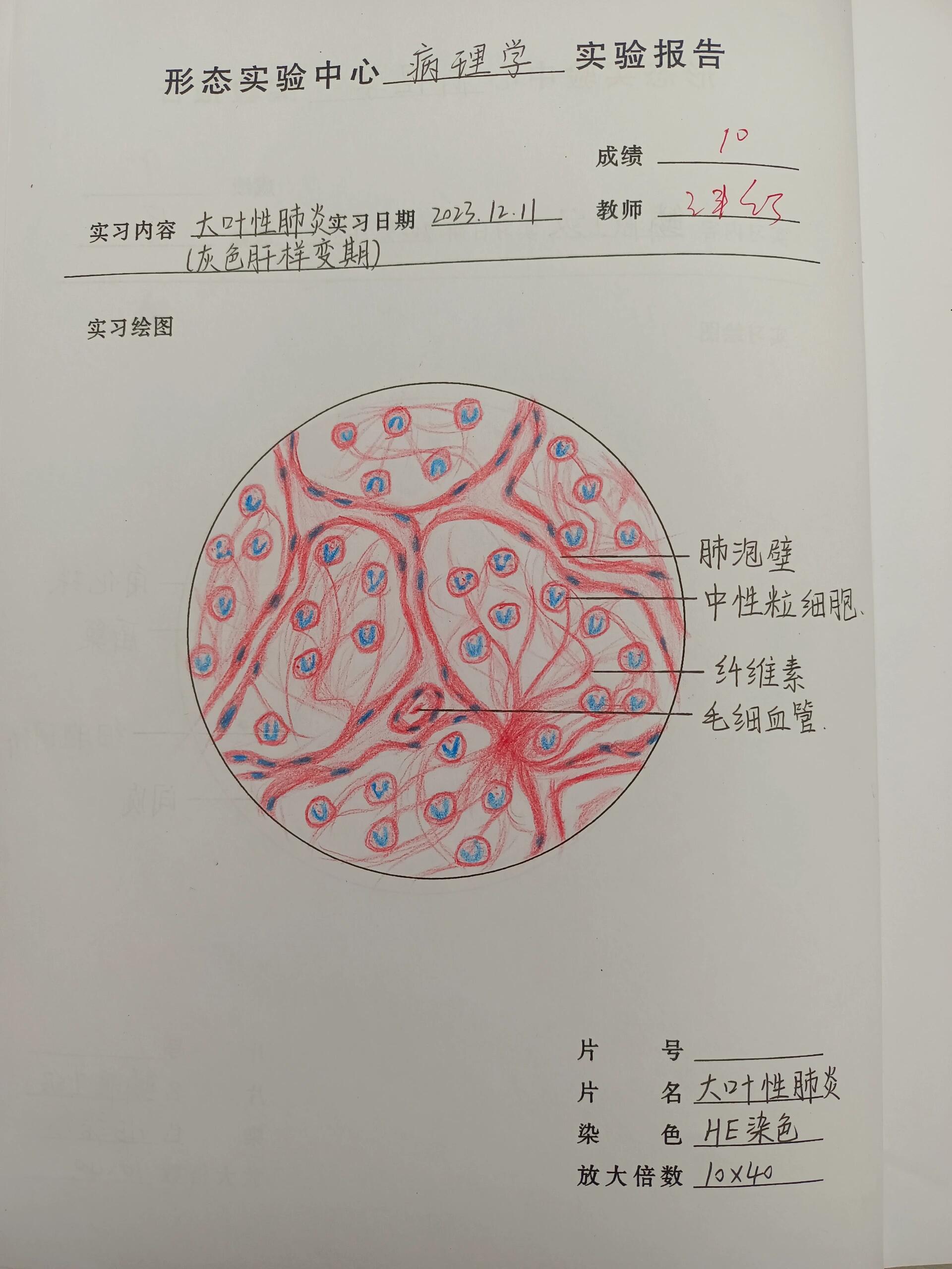 大叶性肺炎病理图图片