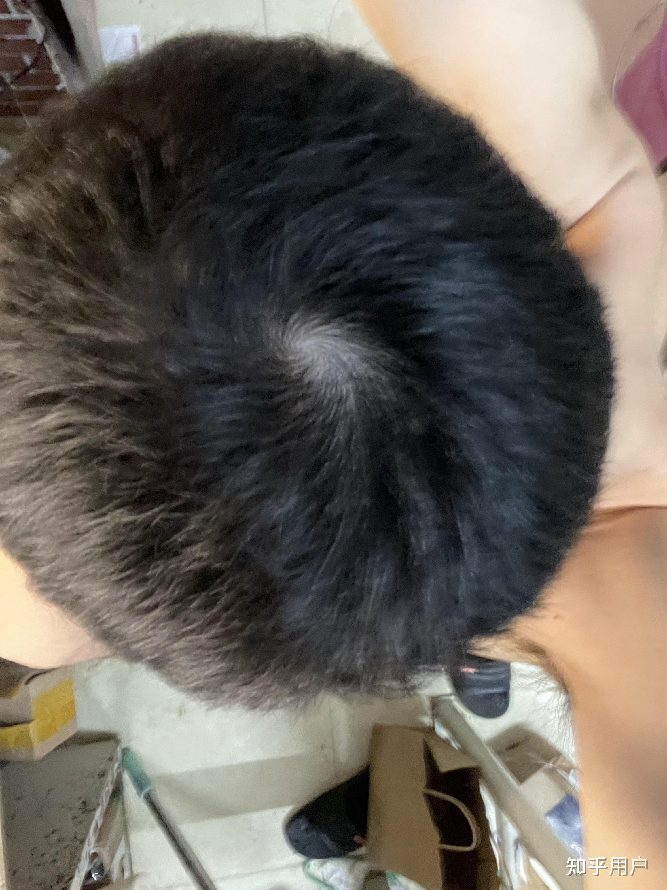 请问下头顶漩处这个发量正常吗