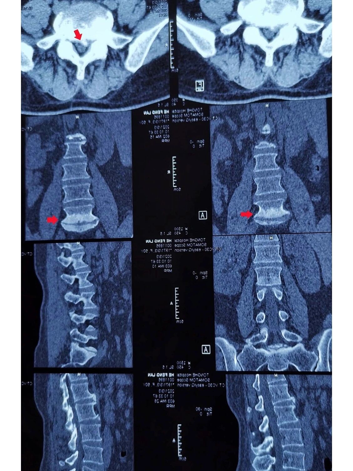 间盘核磁共振椎体终板炎影像学表现骨钙化终板炎图片ct终板炎诊断图片