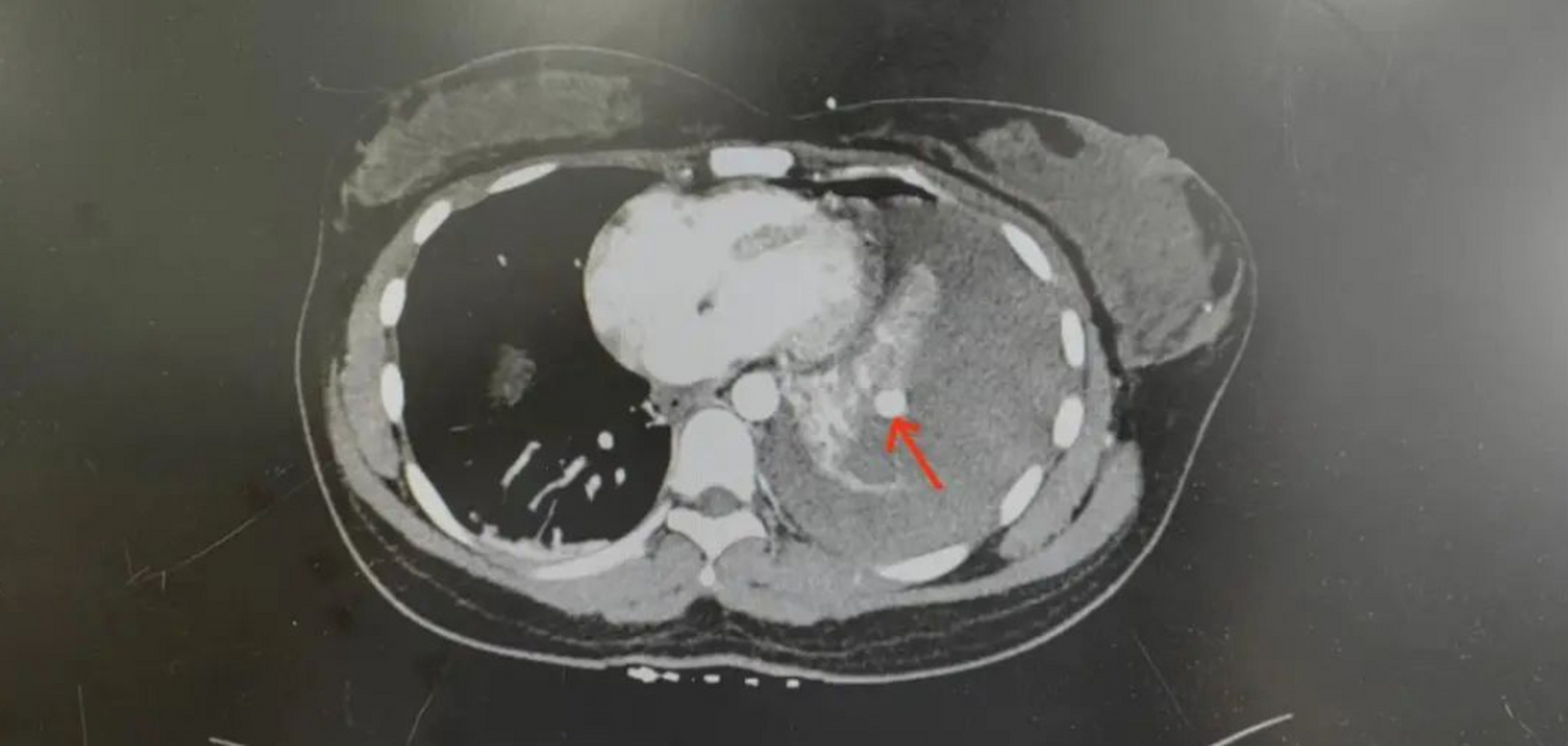 血胸ct图片