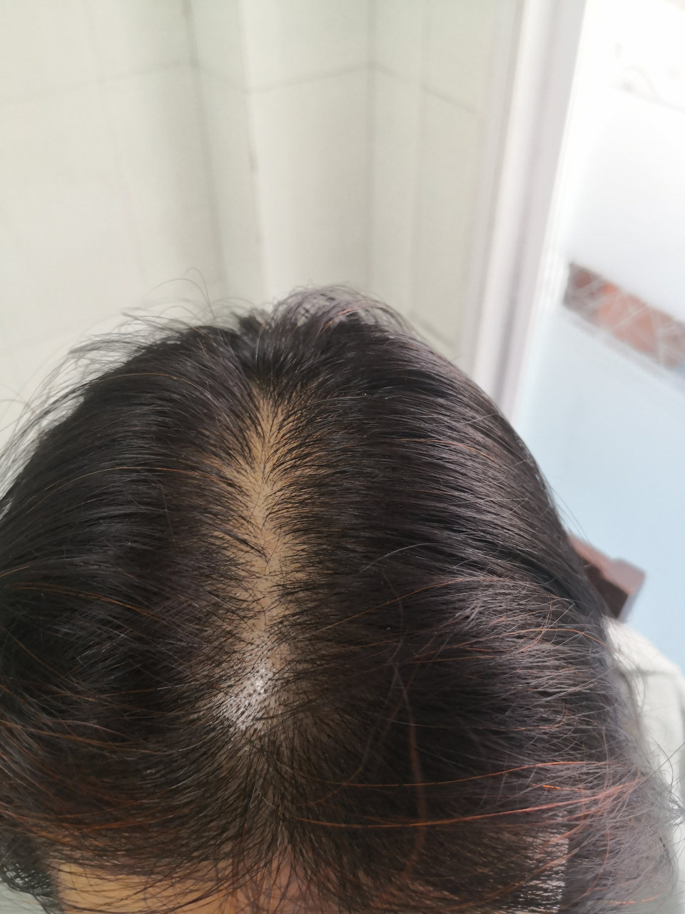 女性型脱发##雄激素性脱发##脱发
