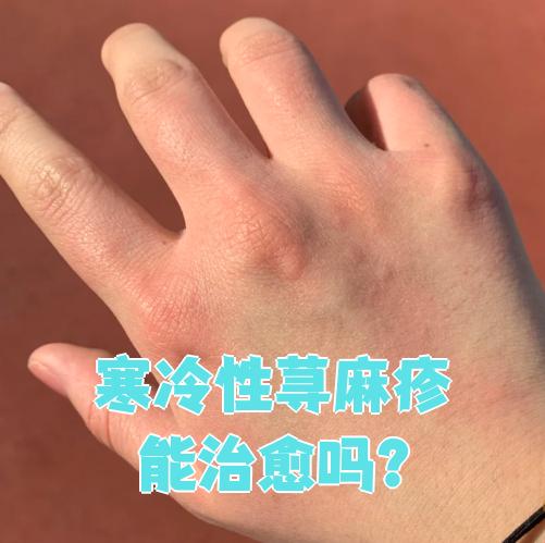 荨麻疹为什么冷水一冲就好了的简单介绍 荨麻疹为什么冷水一冲就好了的简单介绍