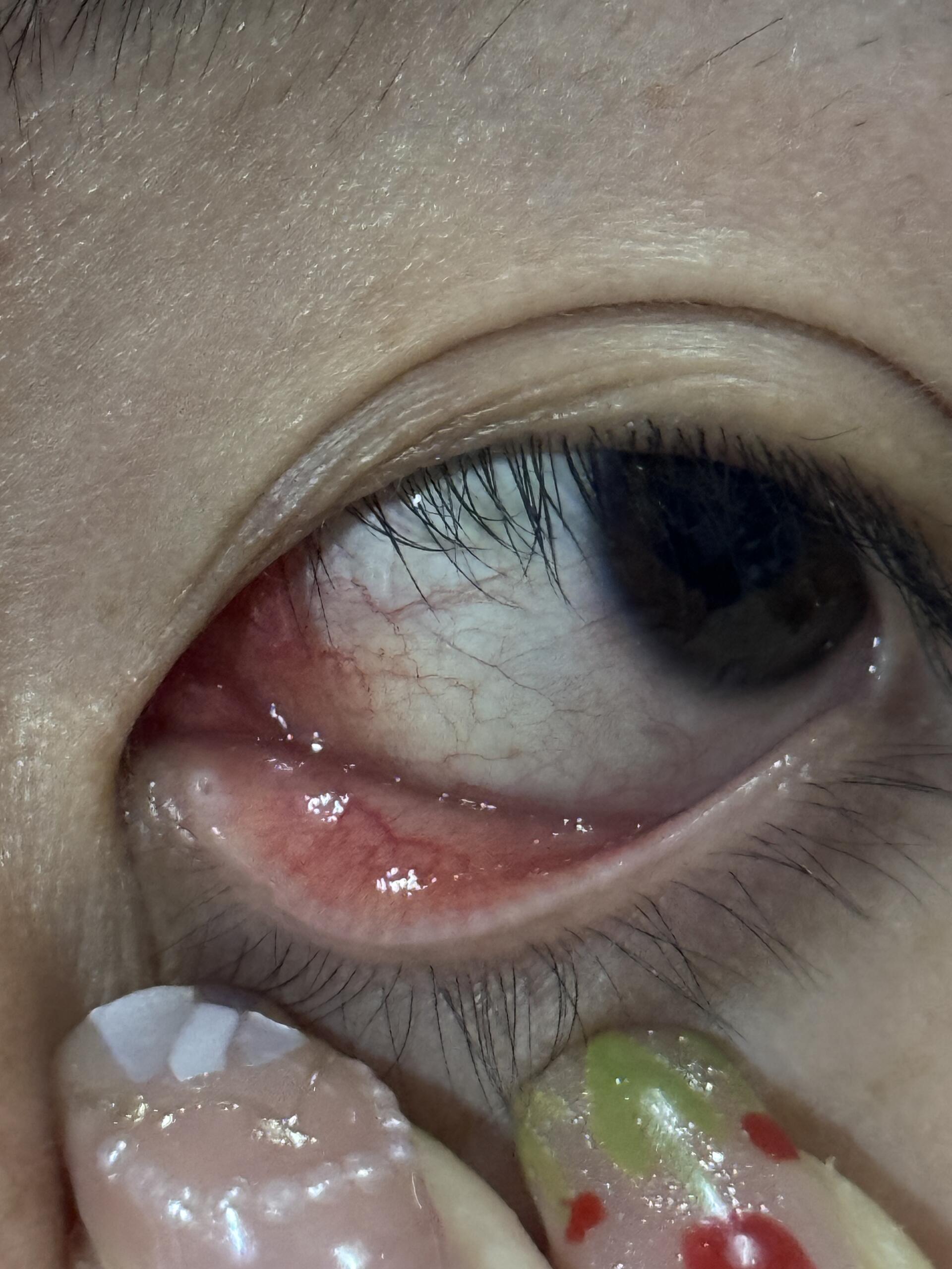 去学校医务室开了药,滴了的确不痒了,但是眼角那里还在发炎,红并且肿