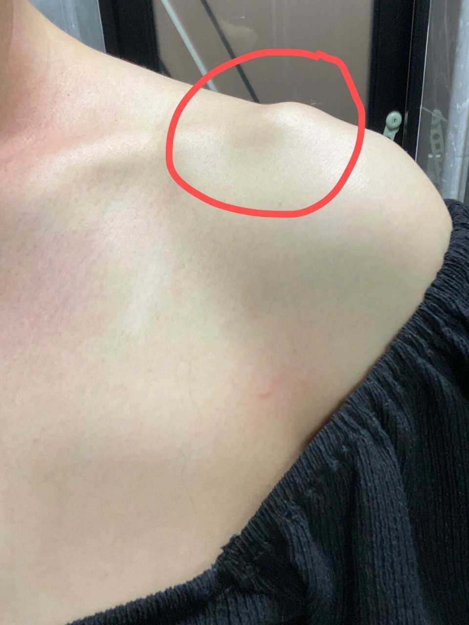 为什么我肩膀两边这个骨头这么突,像两个角一样,我看很多人都是平的