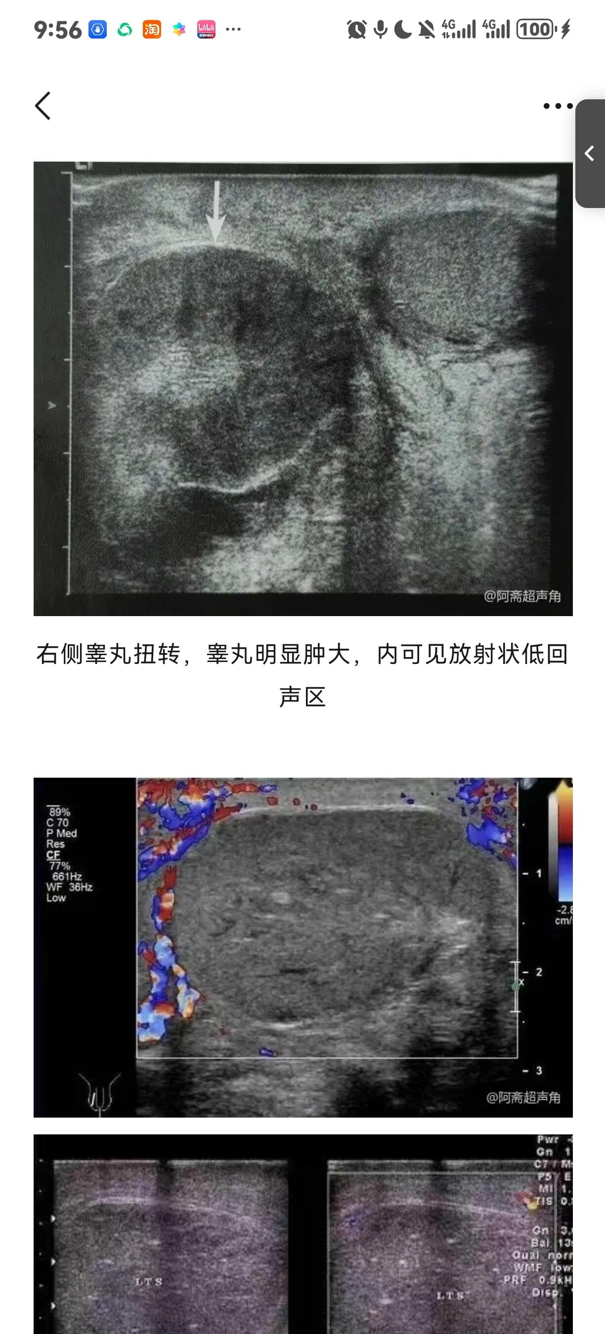 睾丸肿瘤超声表现图片图片