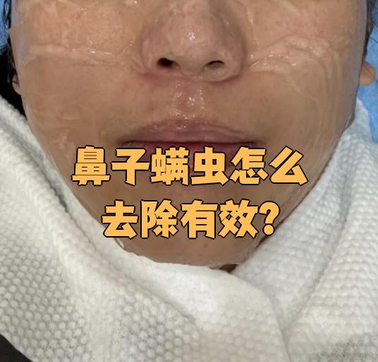 鼻子螨虫可以用药物治疗,果酸换肤,激光治疗这些方法解决
