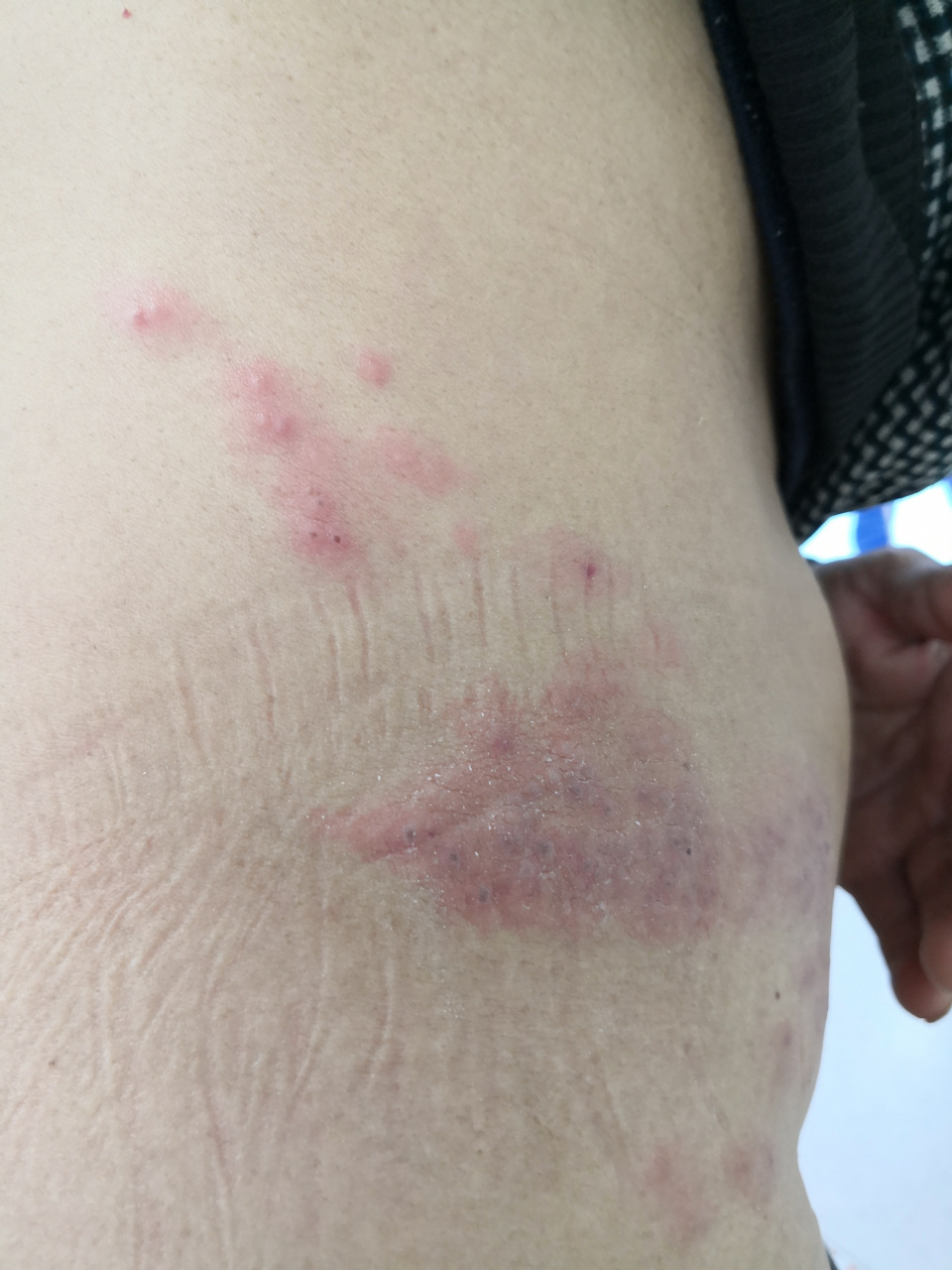 带状疱疹症状.腰部带状疱疹.带状分布红斑水疱#带状疱疹