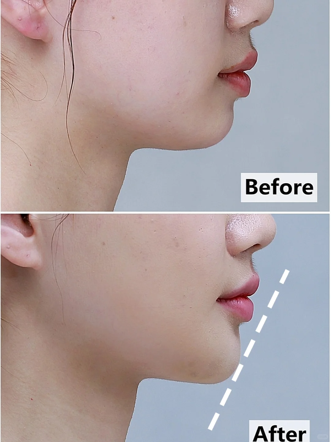 最近很多小姐妹们都在问我打下巴选什么材料,我马上她分享了自己注射