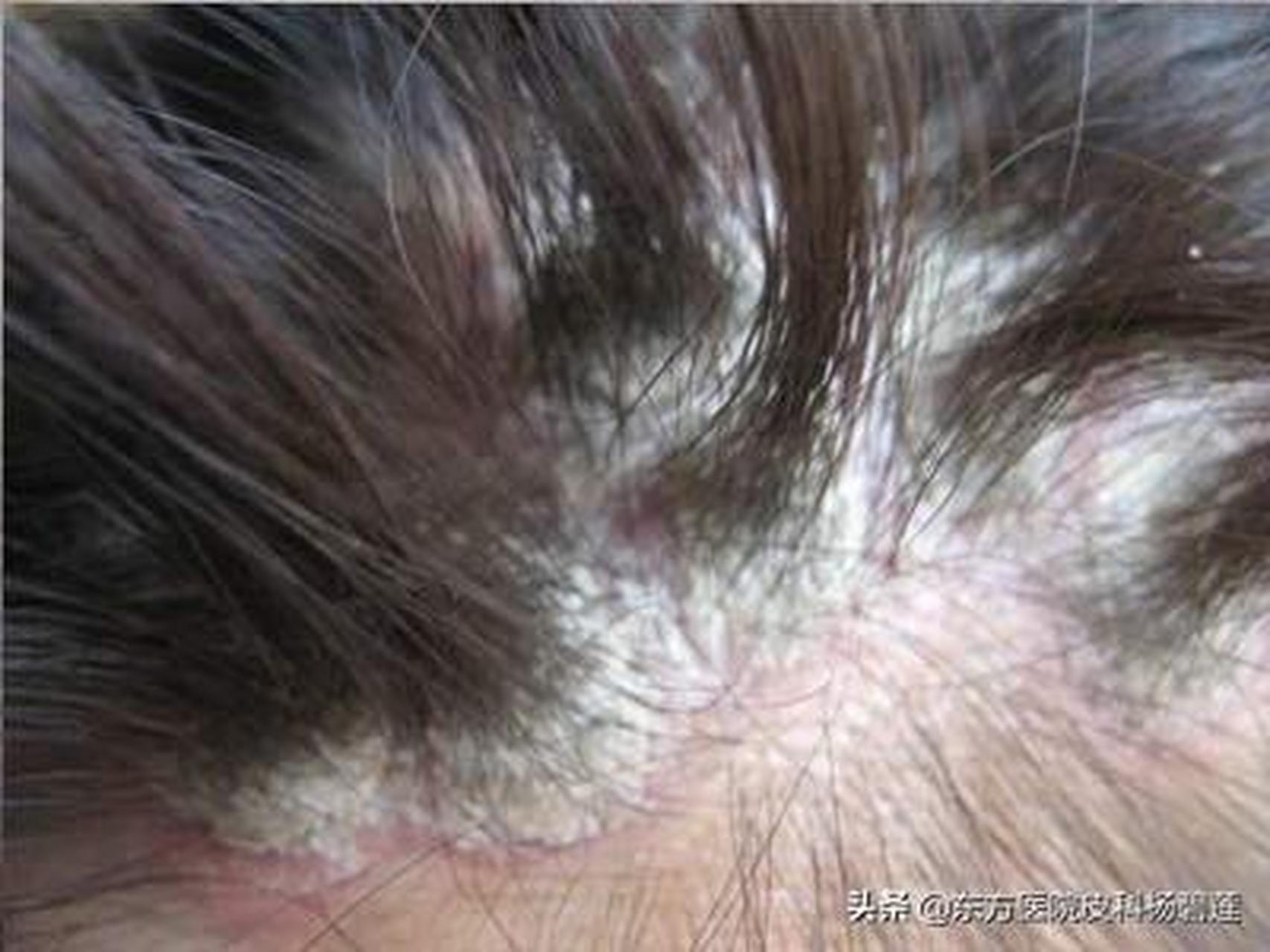 头癣和头皮型银屑病的区别是什么?