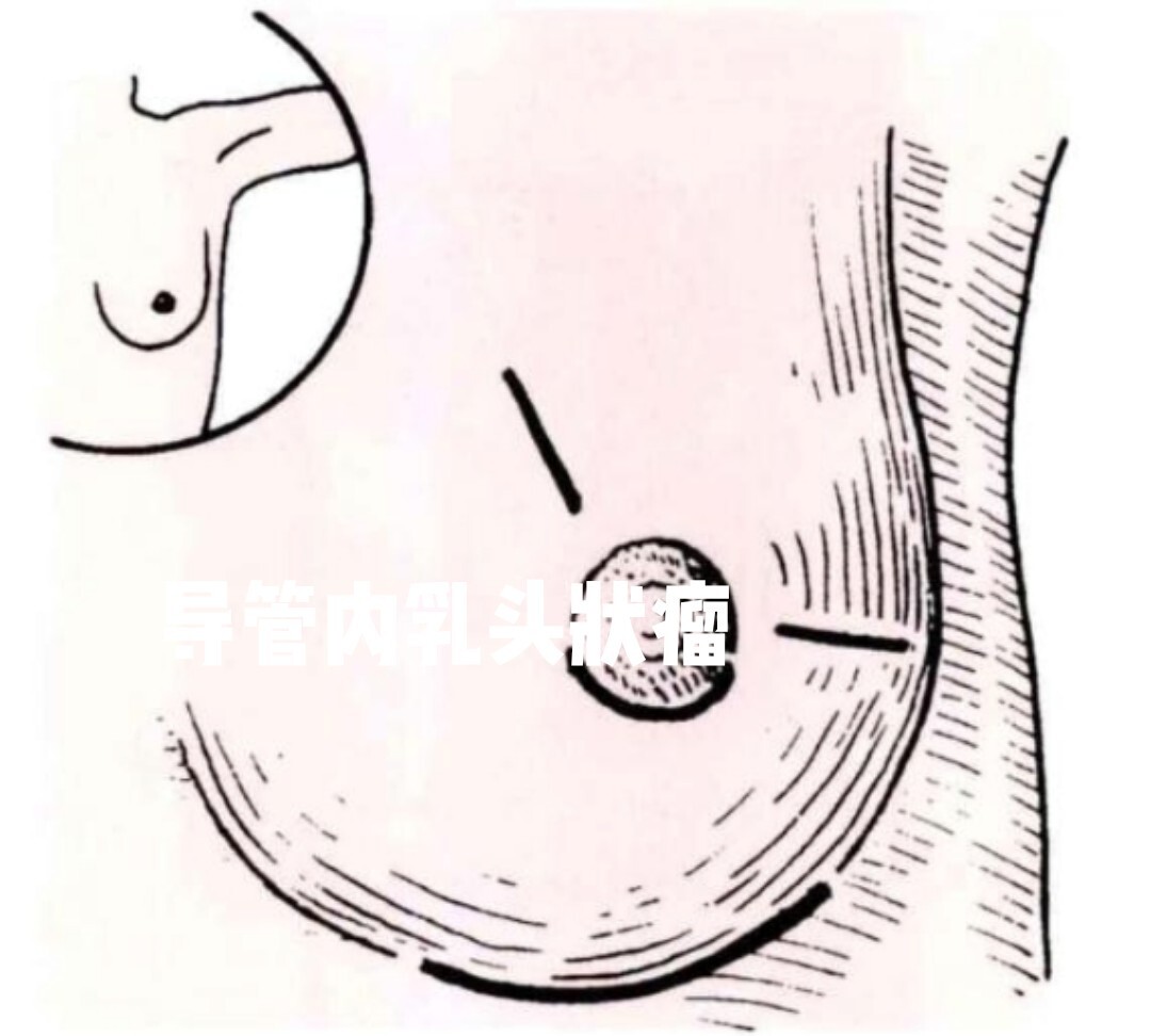 导管内乳头状瘤分为中央型和外周型