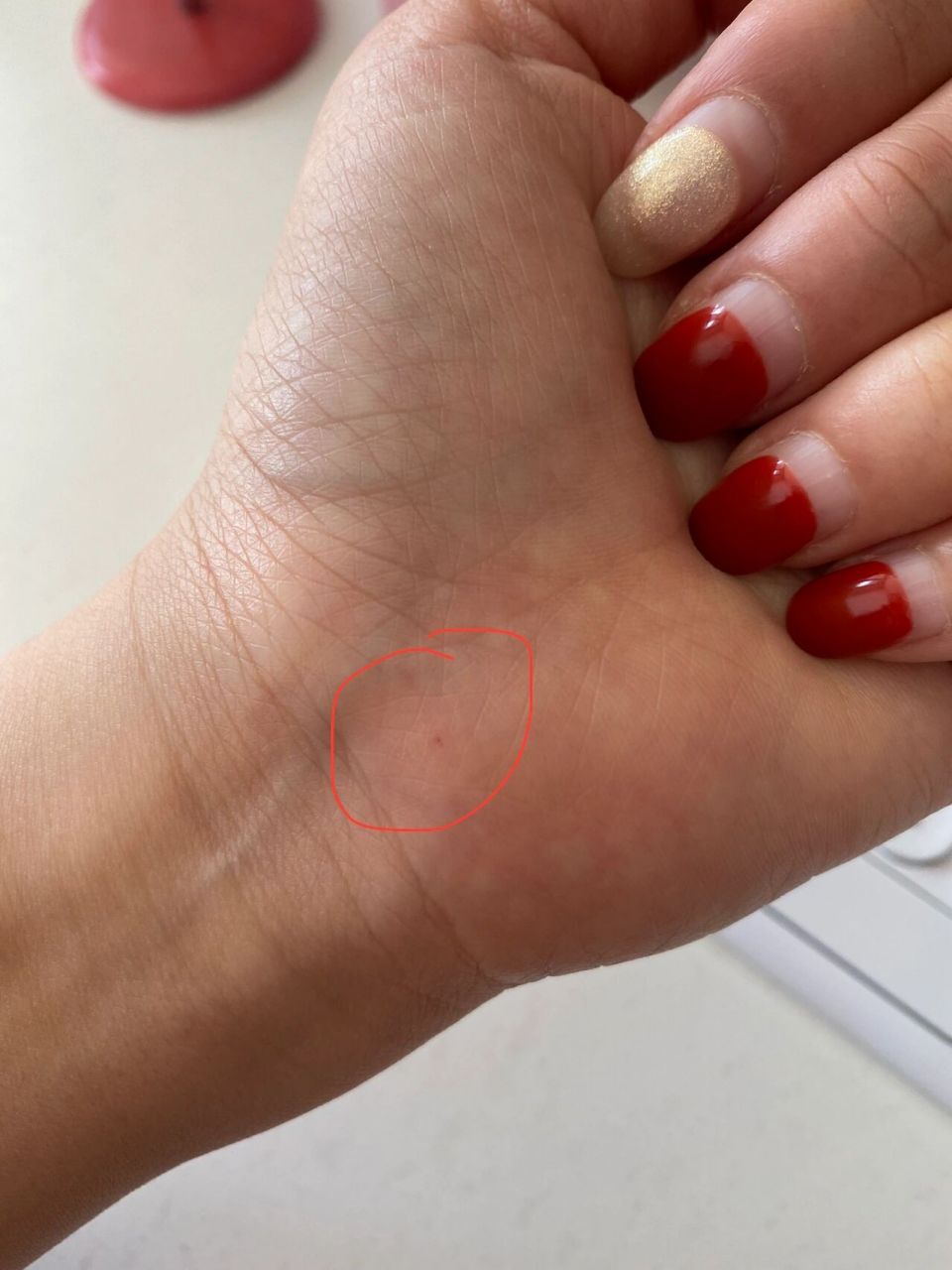 原来朱砂痣是真实存在的… 这个小红点长了几年了 起初我以为是不