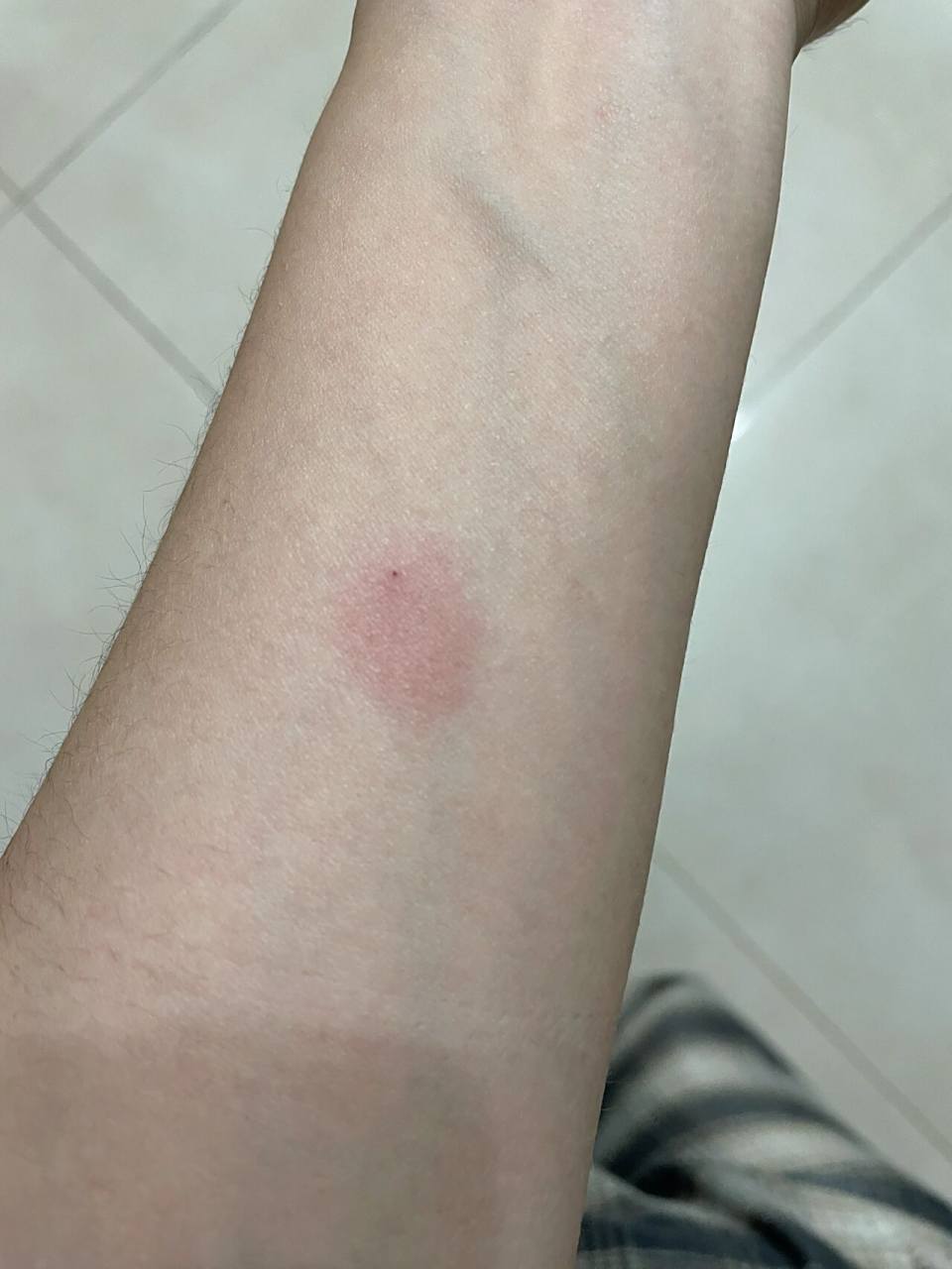 ppd皮试第二天 皮试后28个多小时的样子,还有43个小时