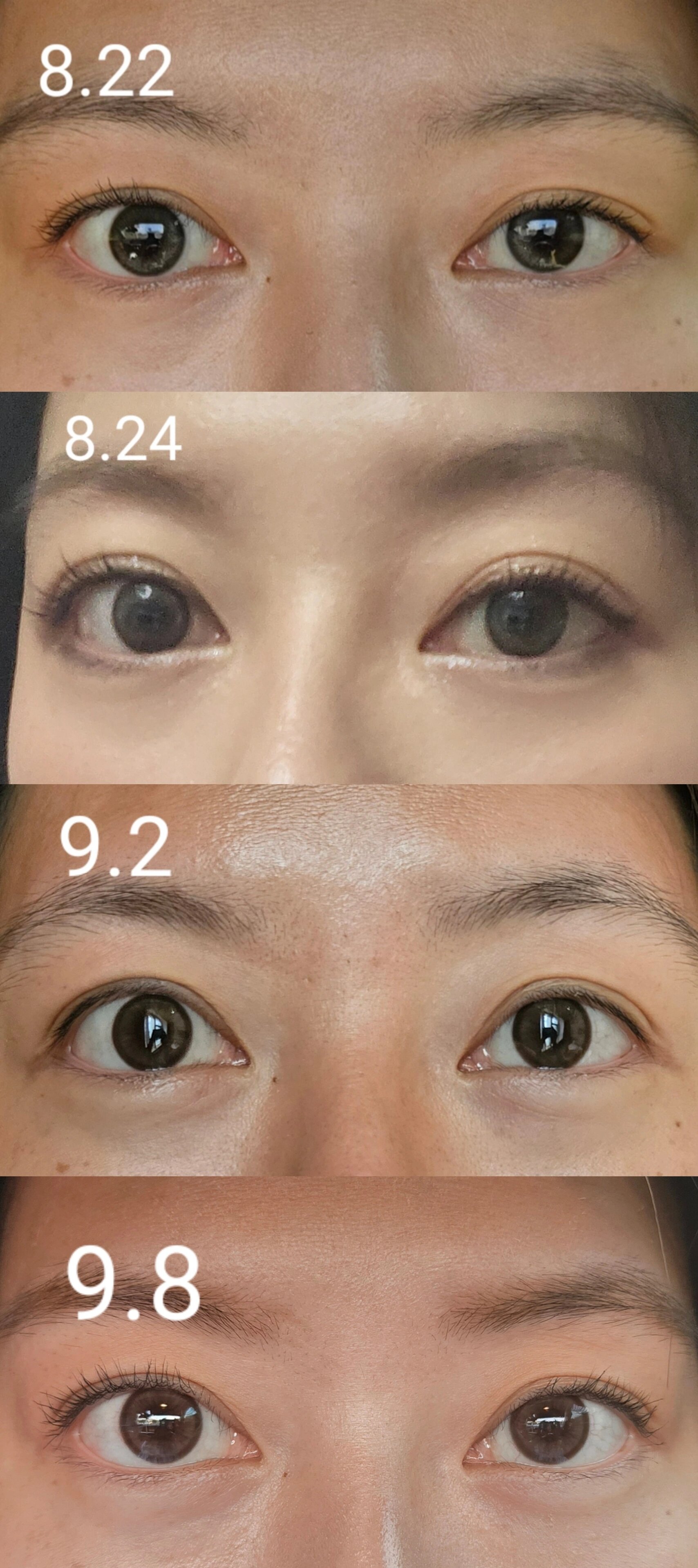 甲亢大小眼注射曲安奈德分享