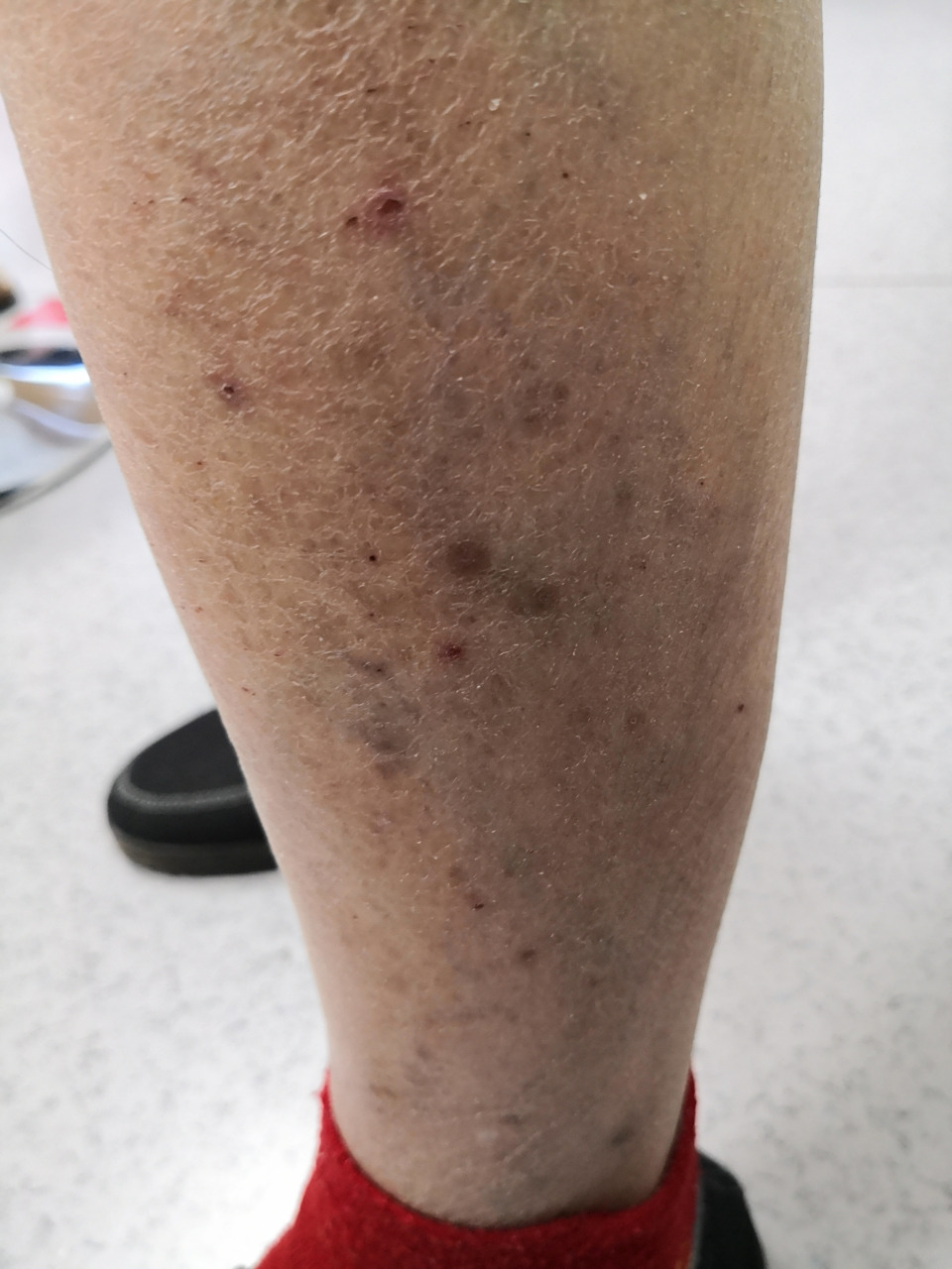 双侧小腿淤积性皮炎症状#下肢静脉曲张##皮炎