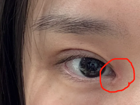 内眼角疤痕增生如何消除