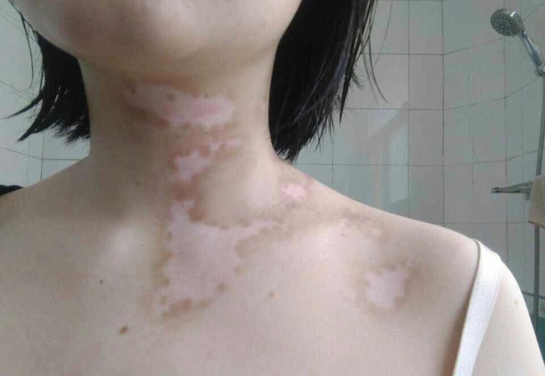 可以从以下4个方面考虑  1,早期白癜风多呈现出不明显的小白点,白斑