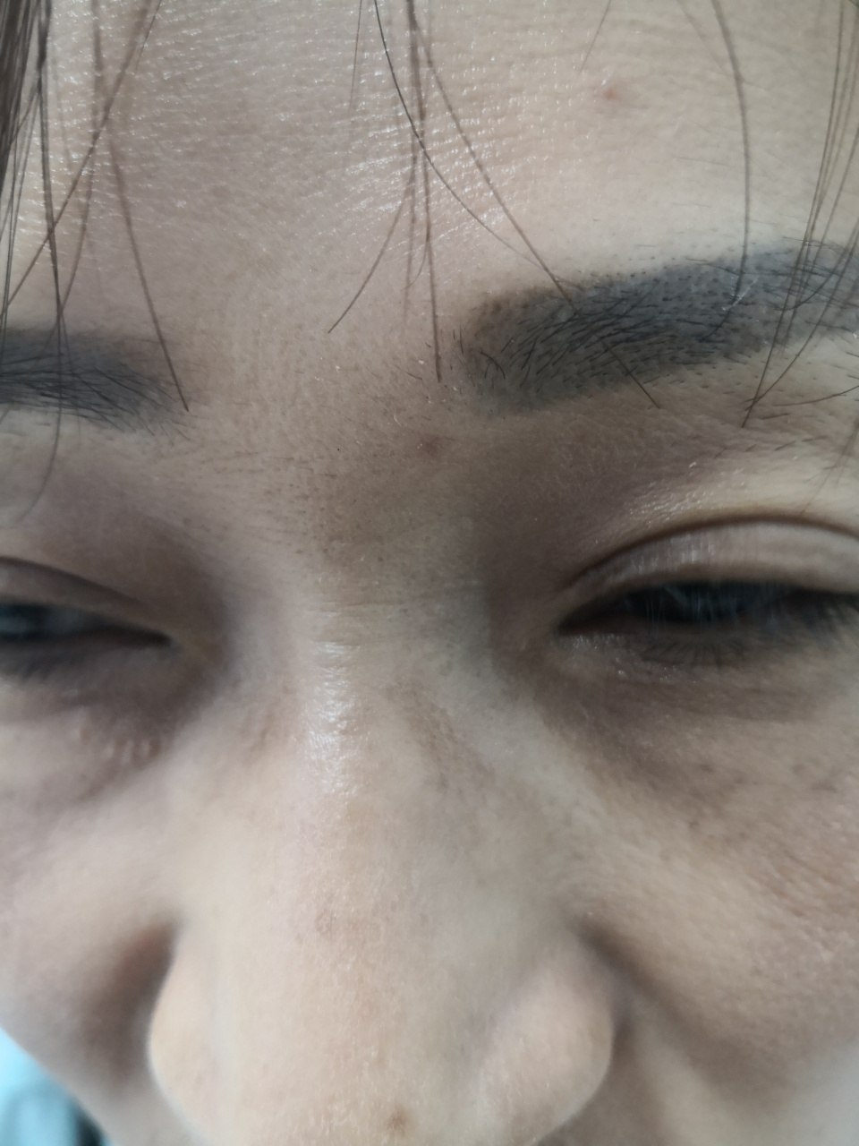 面颊颧骨部位和鼻梁根部两侧的黄褐色斑片.