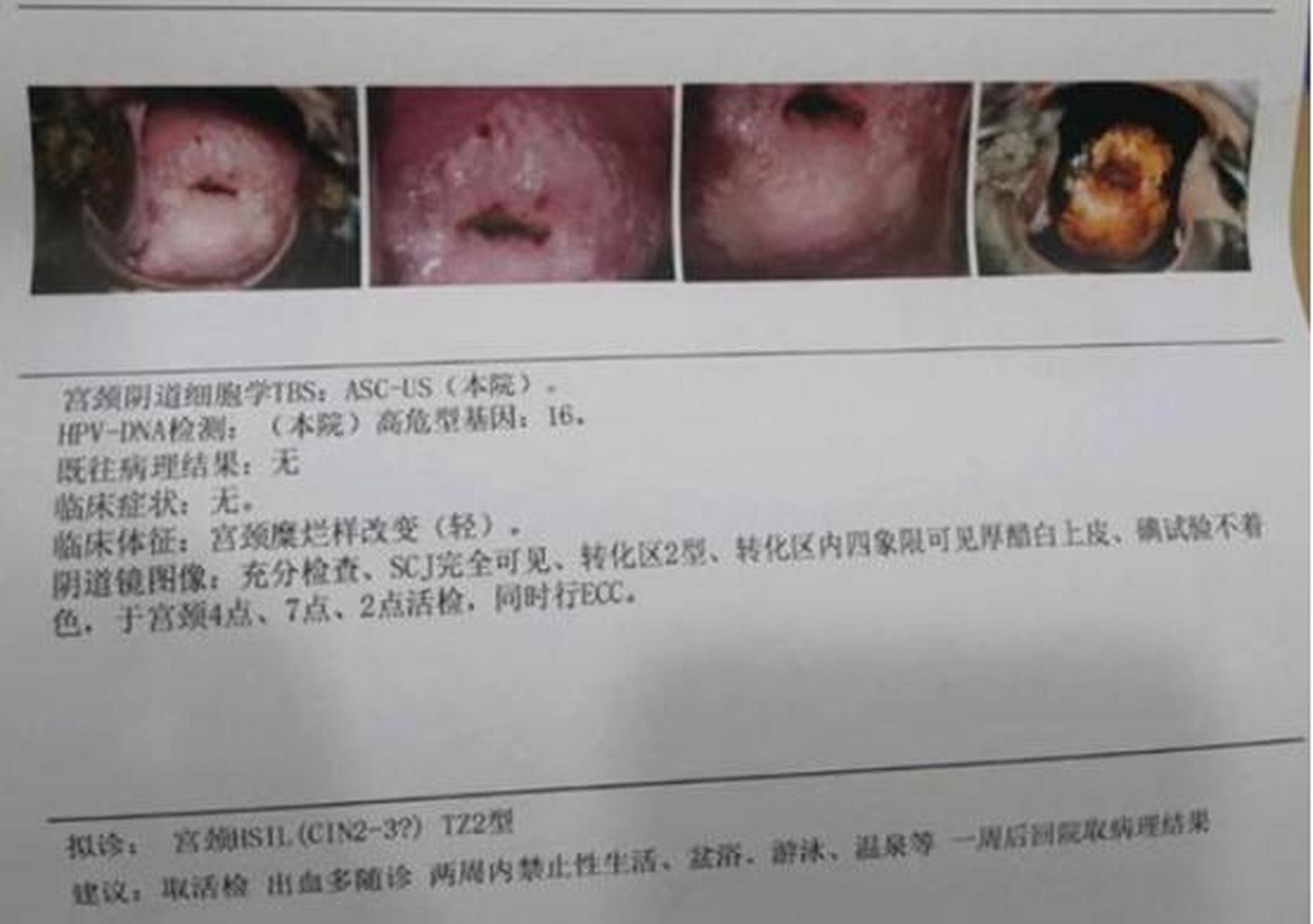 20年了,没有性生活,一检查就是宫颈癌前高级别病变,这是怎么回事呢?