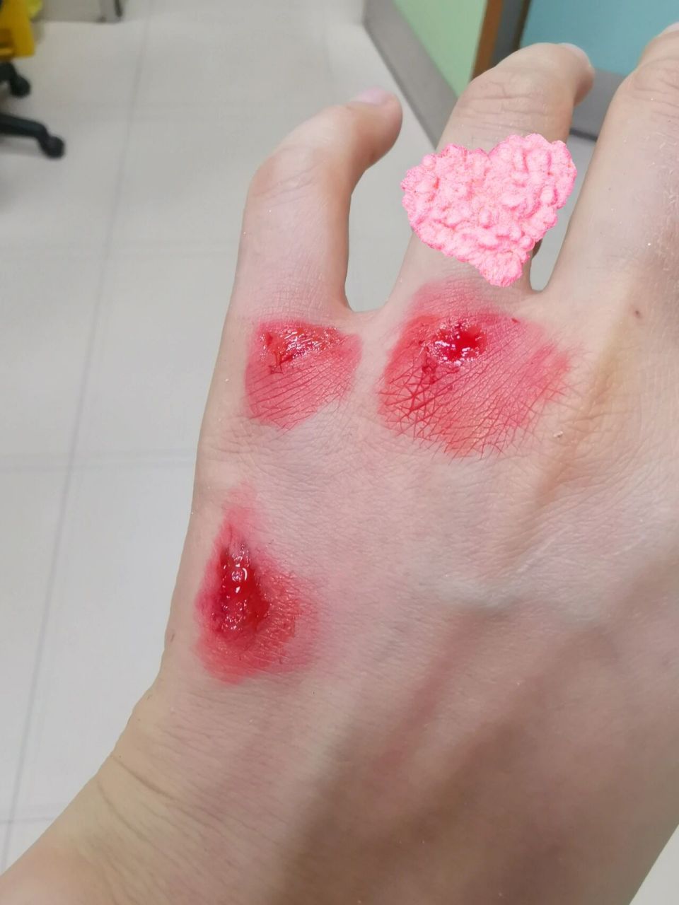 下雨天 摔倒 手机报废 最重要人没事, 只是擦伤,手臂擦得厉害点 下