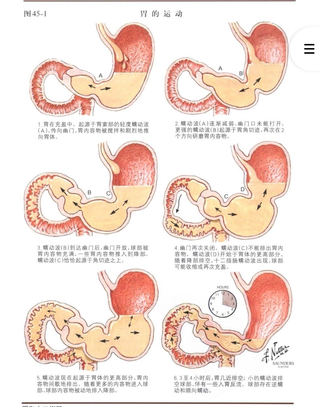 胃排空障碍胃瘫的分类三手术后胃瘫手术后胃瘫常常在毕式胃切除术胃底