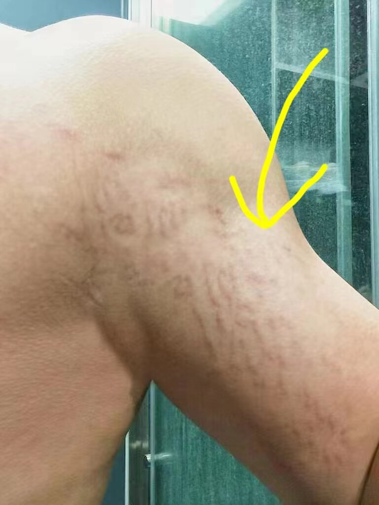 拍图为证!胳膊上的肥胖纹终于淡了!