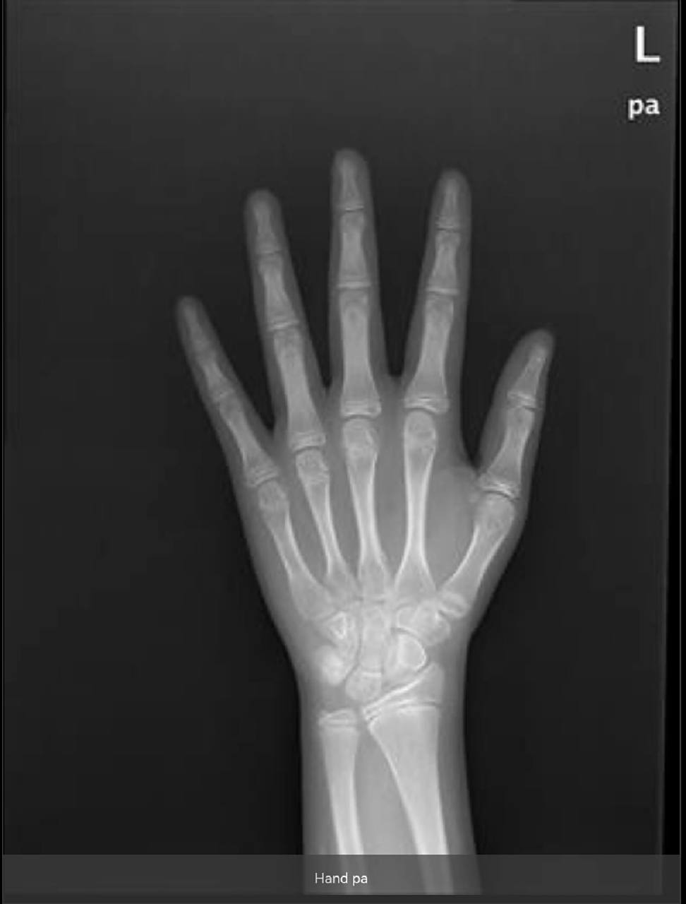 追高笔记:10岁7个月女孩骨龄11岁半-12岁 8岁半胸部开始出现疼痛 第一