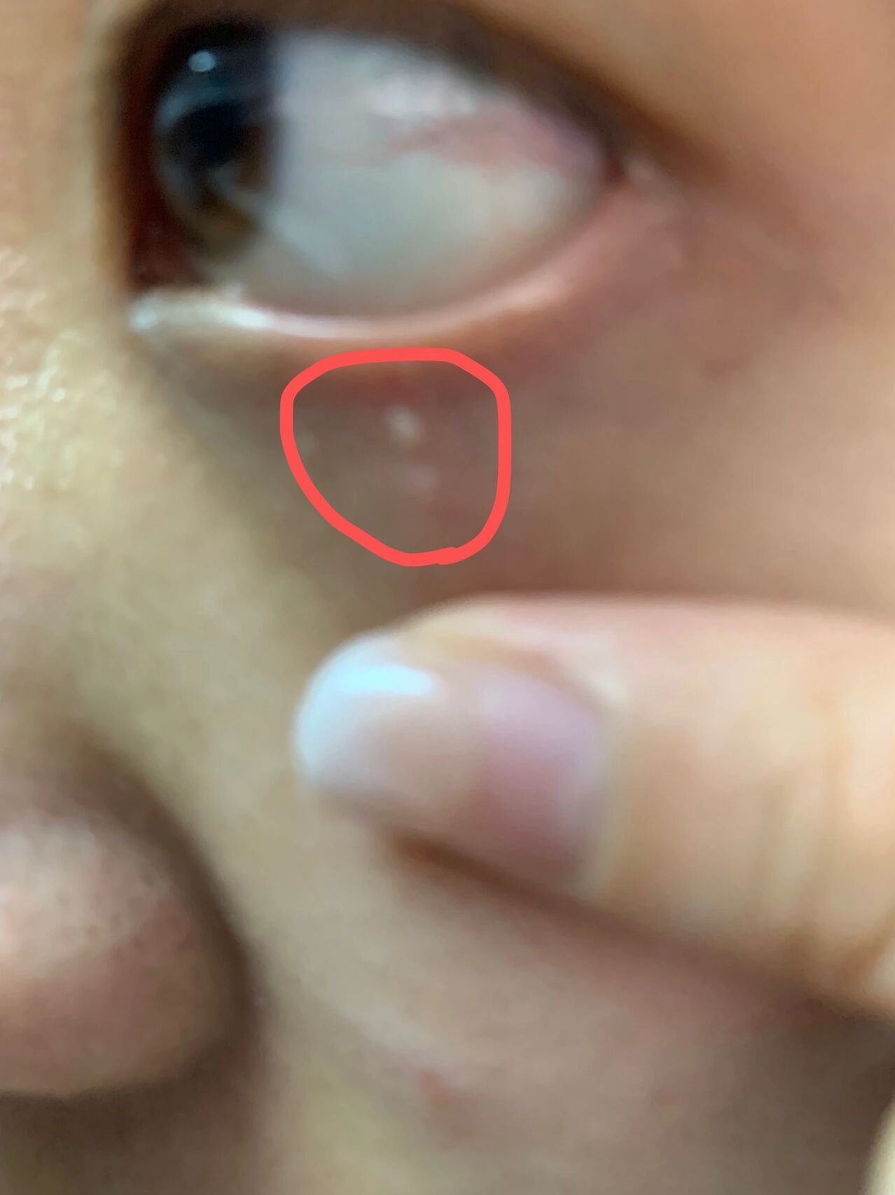 眼部长了白色的颗粒 先问一下大家,这是什么东西啊,在我眼睛周围很久