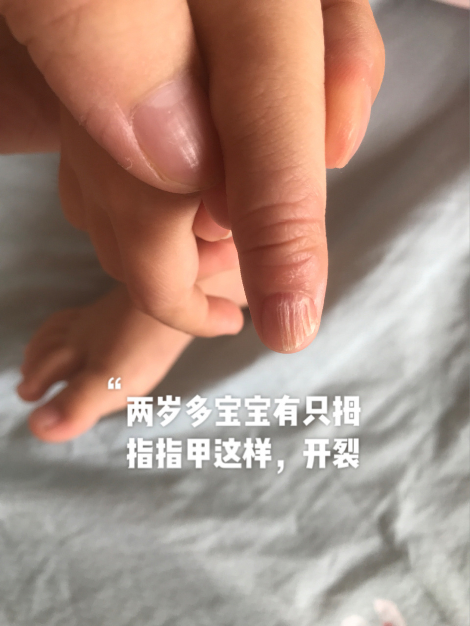两岁多宝宝有只拇指指甲一直这样开裂,看过儿保说发育不好.