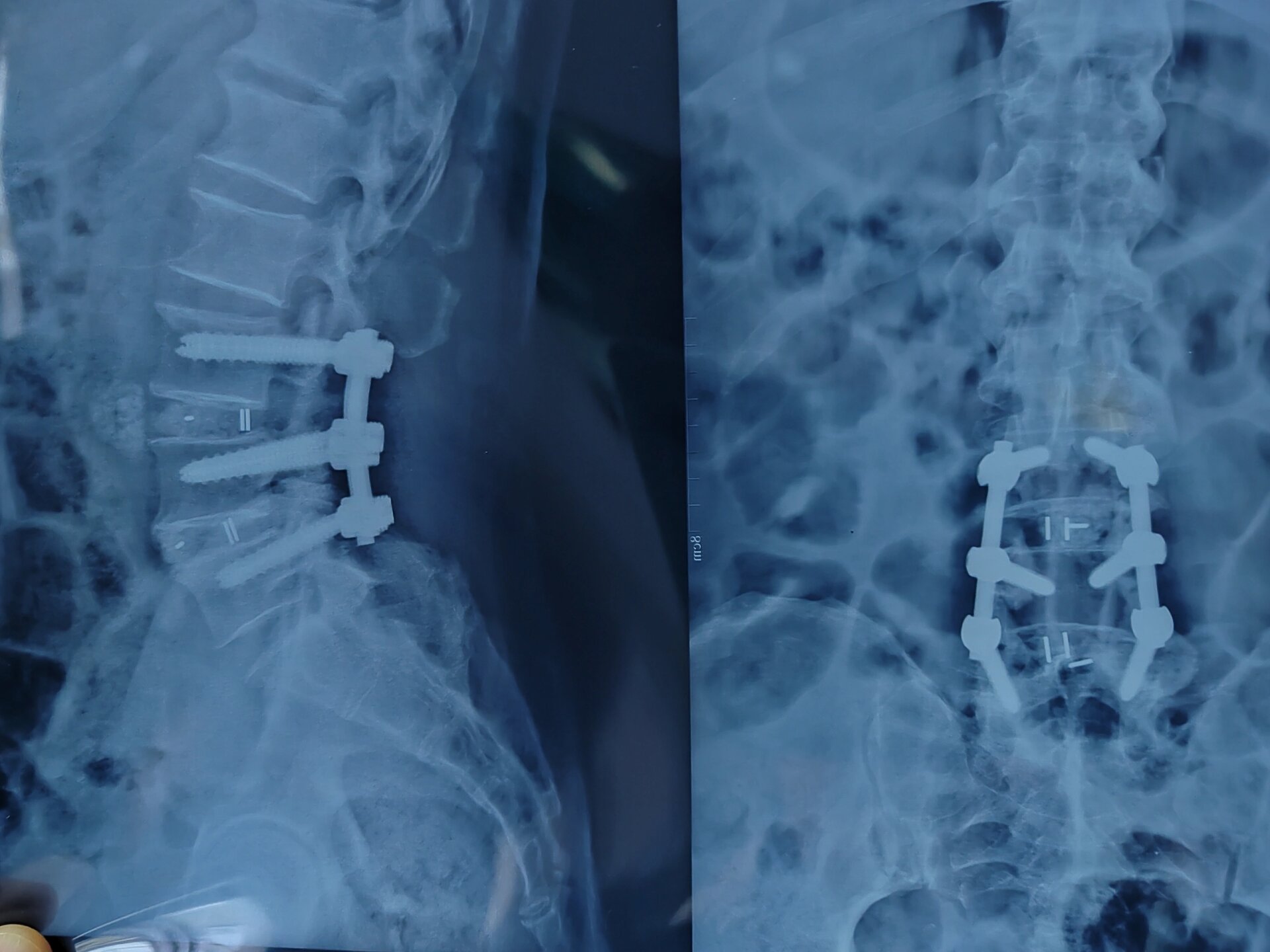 腰椎开放融合术6个钢钉