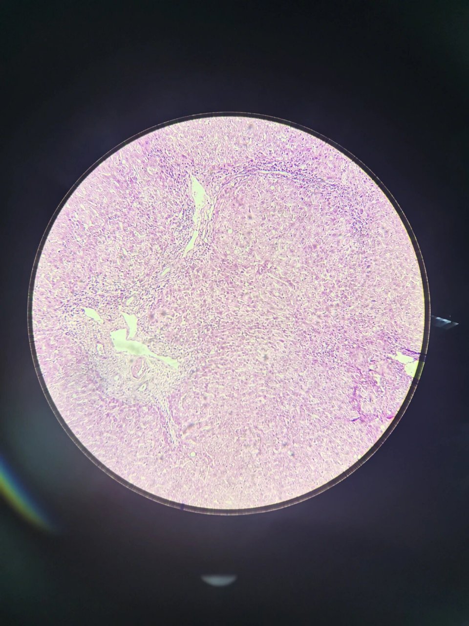 病理学|期末切片复习⑥ 95胃溃疡 镜下描述 ①低倍镜 可见胃粘膜上